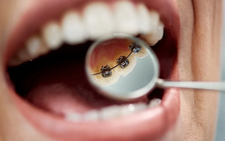 Invisible lingual fixed appliances