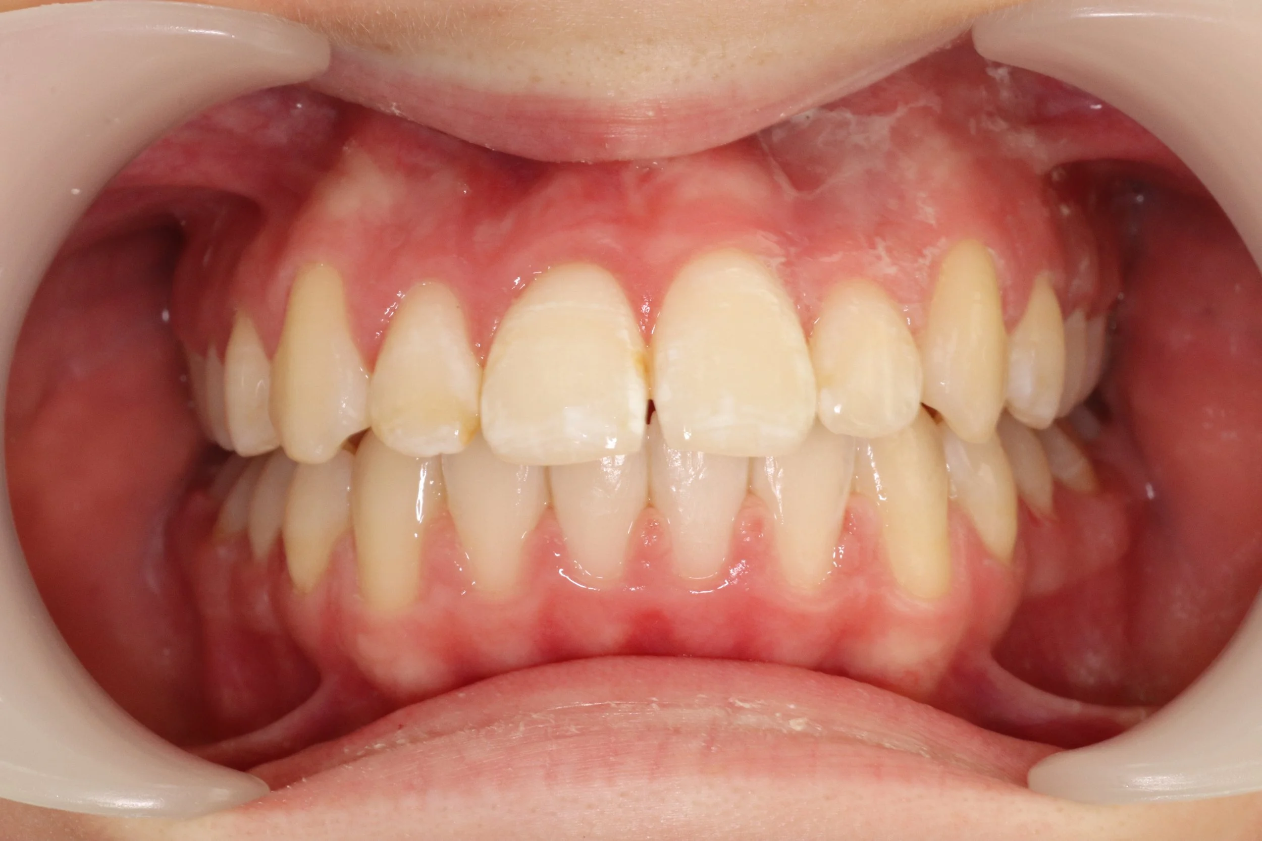 Close-up of a person's mouth showing crooked upper and lower teeth with some crowding and misalignment.