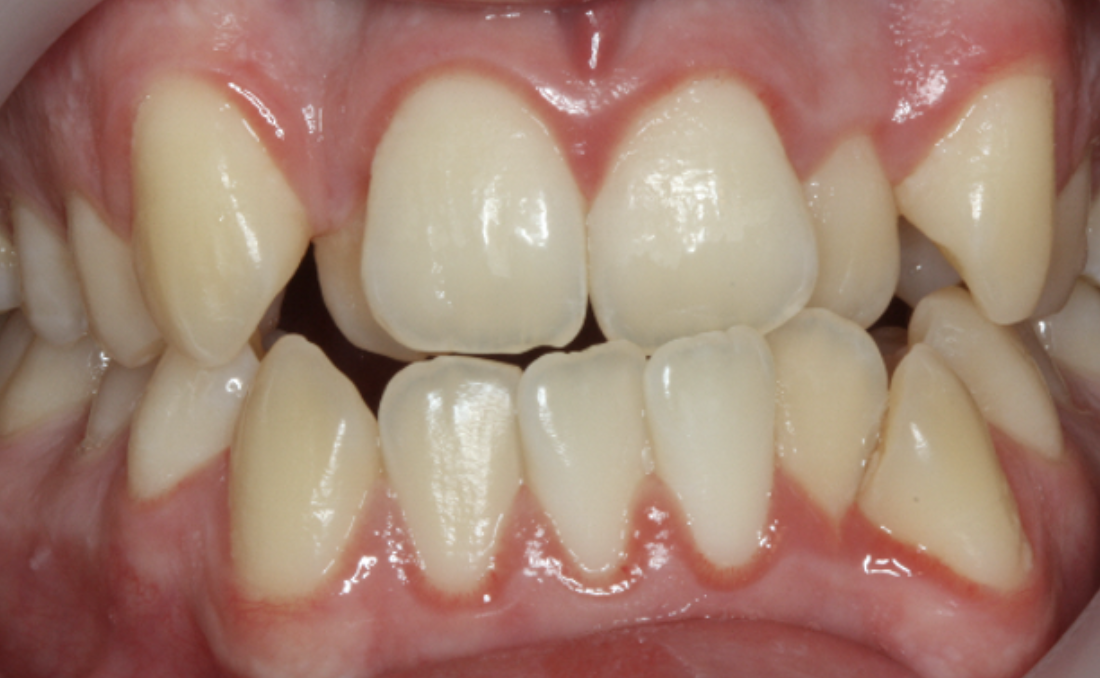 Close-up of a person's mouth showing crooked, misaligned, and overlapping teeth with visible tartar buildup.