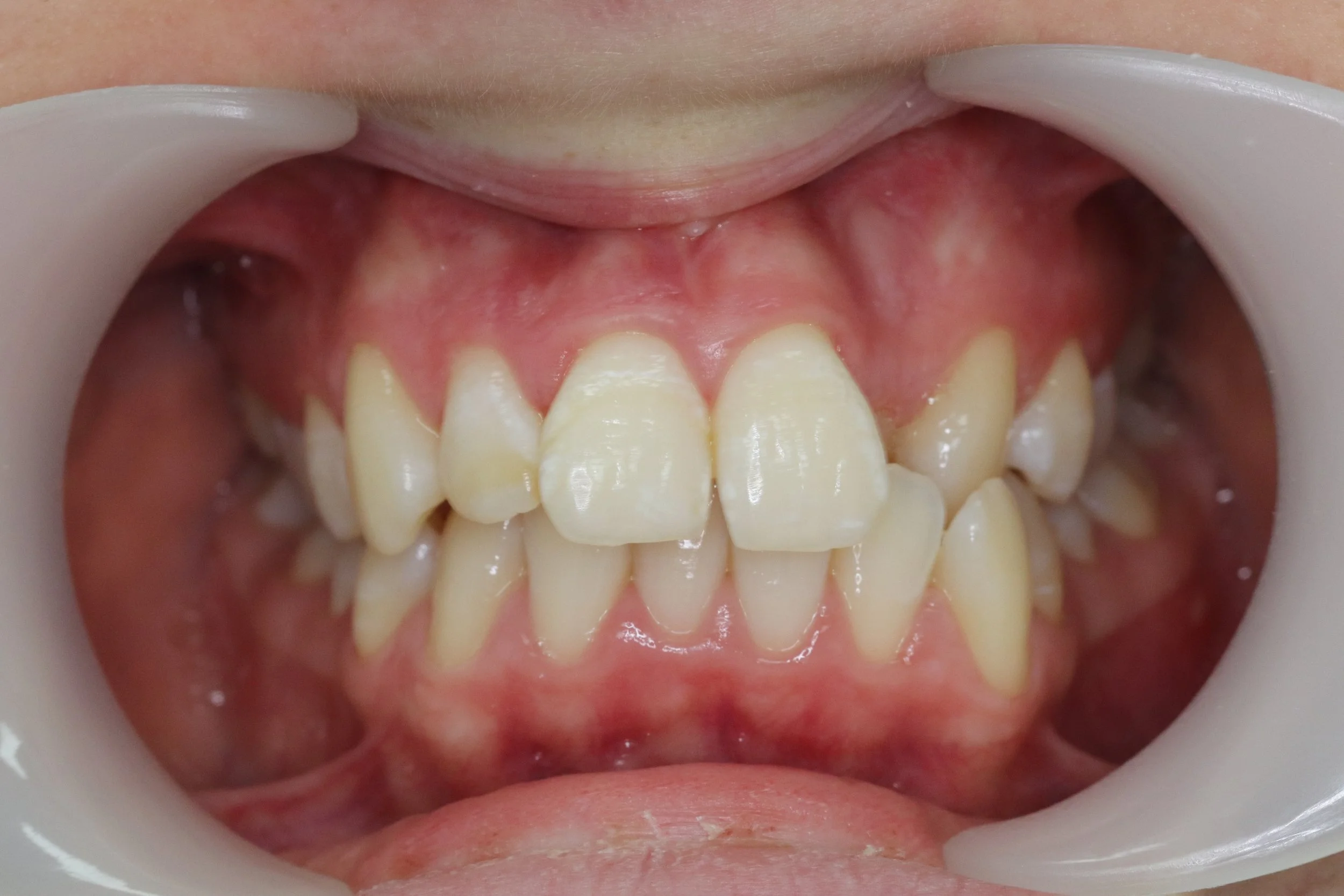 Close-up of a person's upper and lower teeth with crowding and misalignment, held open with dental cheek retractors.