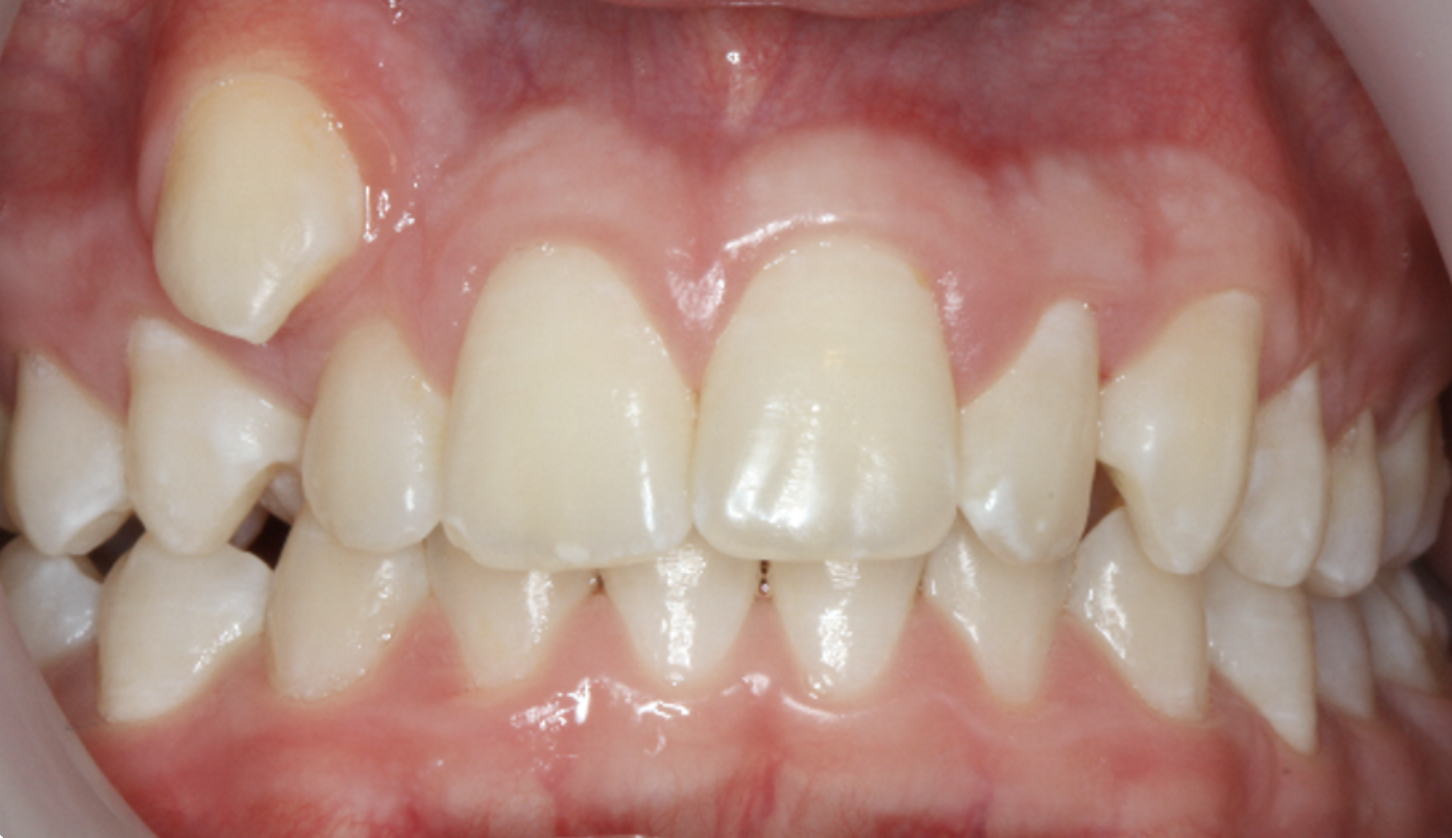 Close-up of a person's teeth showing crowded and misaligned teeth with some gaps and overlapping.