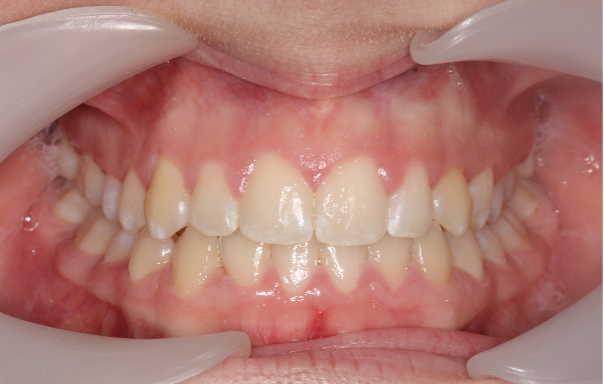 Close-up of a person's open mouth showing teeth and gums, with dental retractors pulling the lips apart.