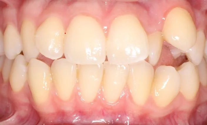 Close-up of a person's teeth showing crowding and overlapping, with some misalignment.