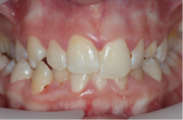 Close-up of a person's teeth with misalignment and crowding