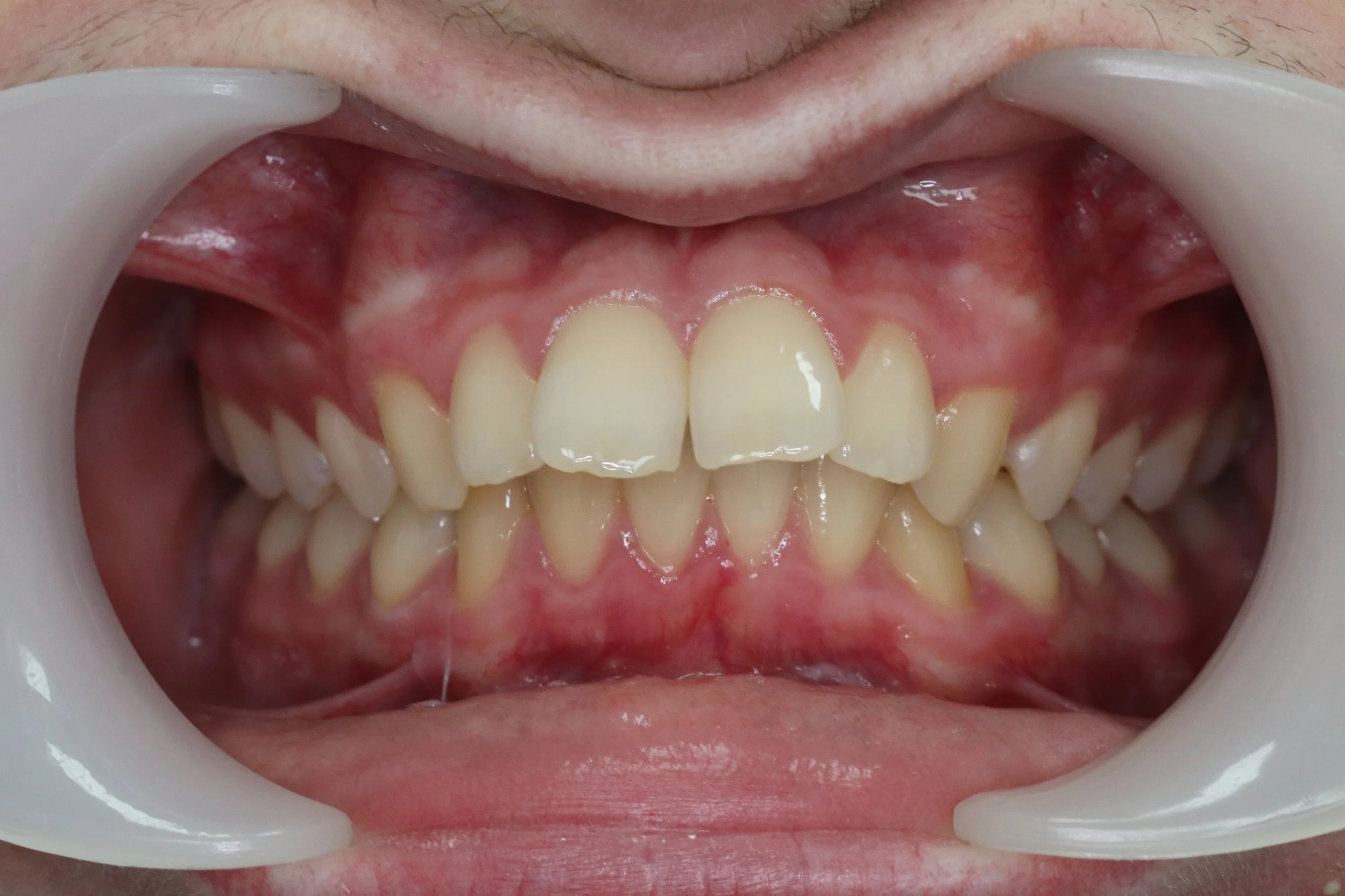 Close-up of a person's mouth with dental retractor, showing teeth and gums.