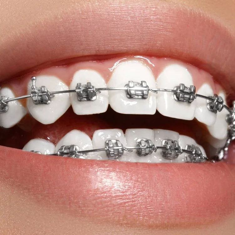 Metal fixed orthodontic appliances