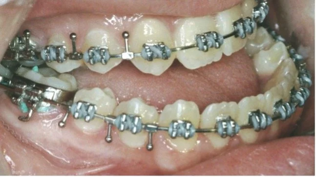 Close-up of teeth with metal braces on upper and lower jaws.