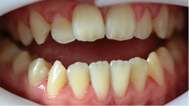 Close-up of a person's teeth showing misalignment and crowding.