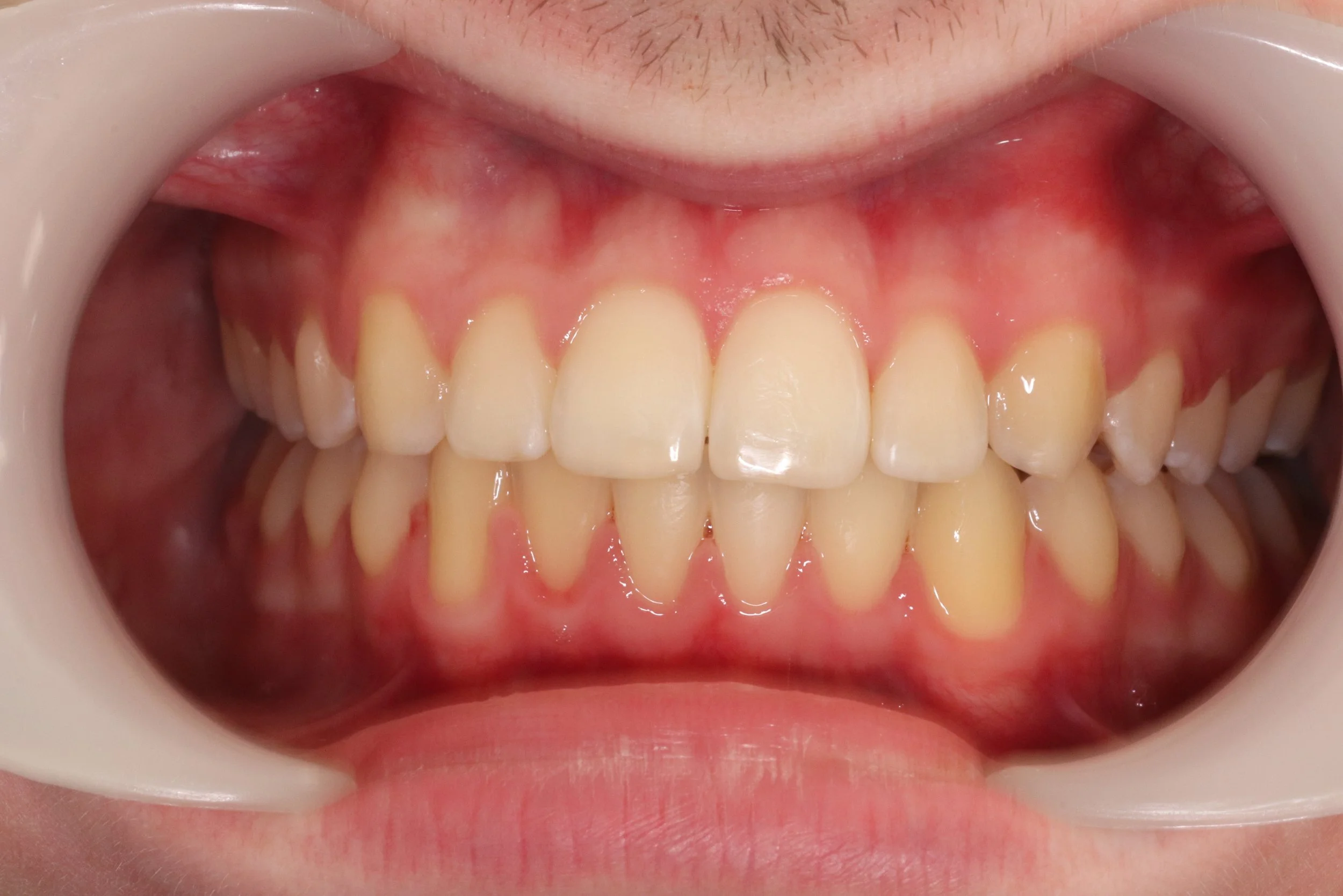 Close-up of a person's open mouth showing upper and lower teeth, with some misalignment and minor crowding, and red and healthy gums.