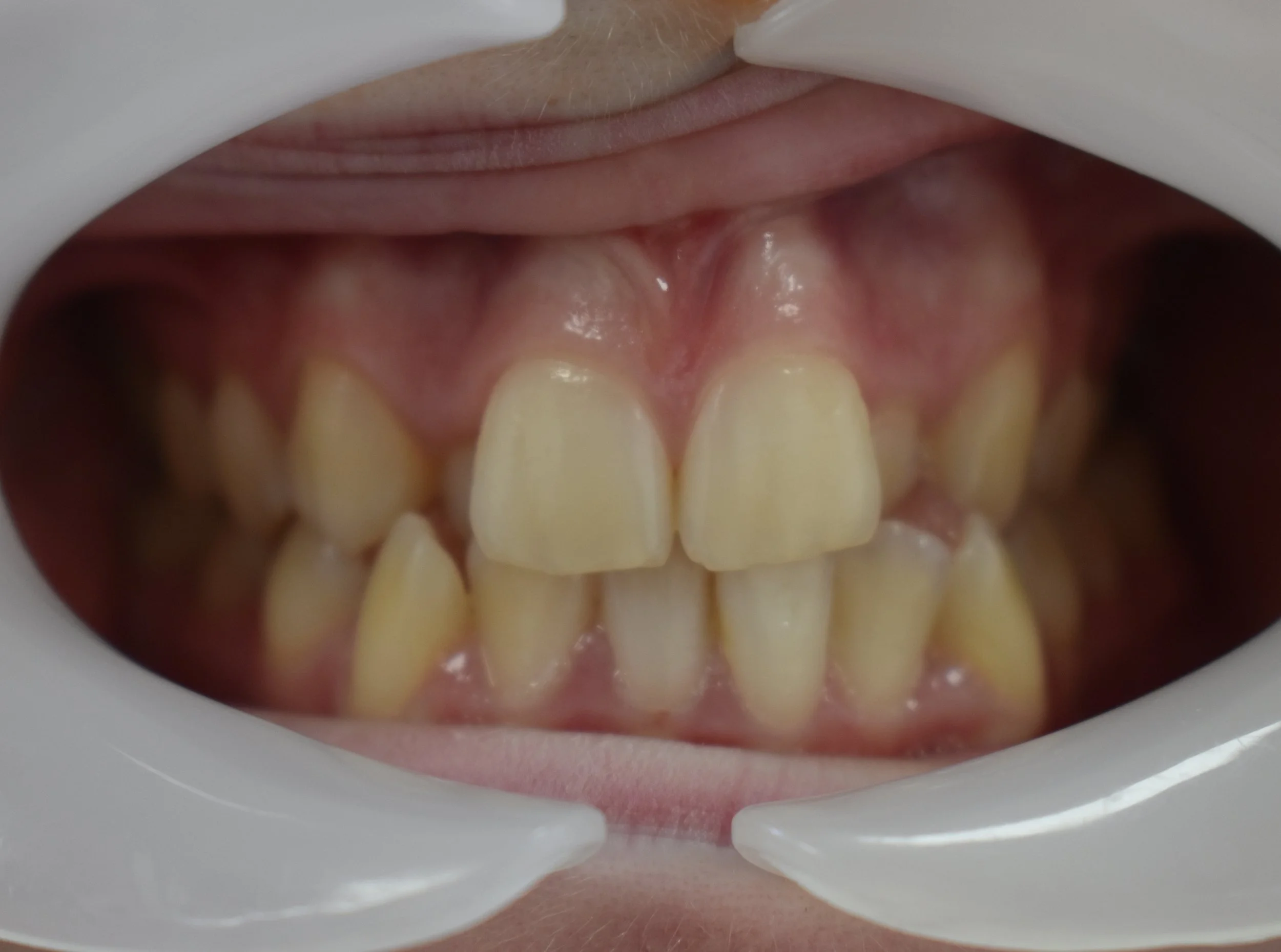 Close-up of teeth with dental retractor showing upper and lower front teeth with some crowding and discoloration.