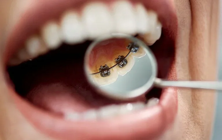 Lingual-Braces-or-Invisalign-img1.webp