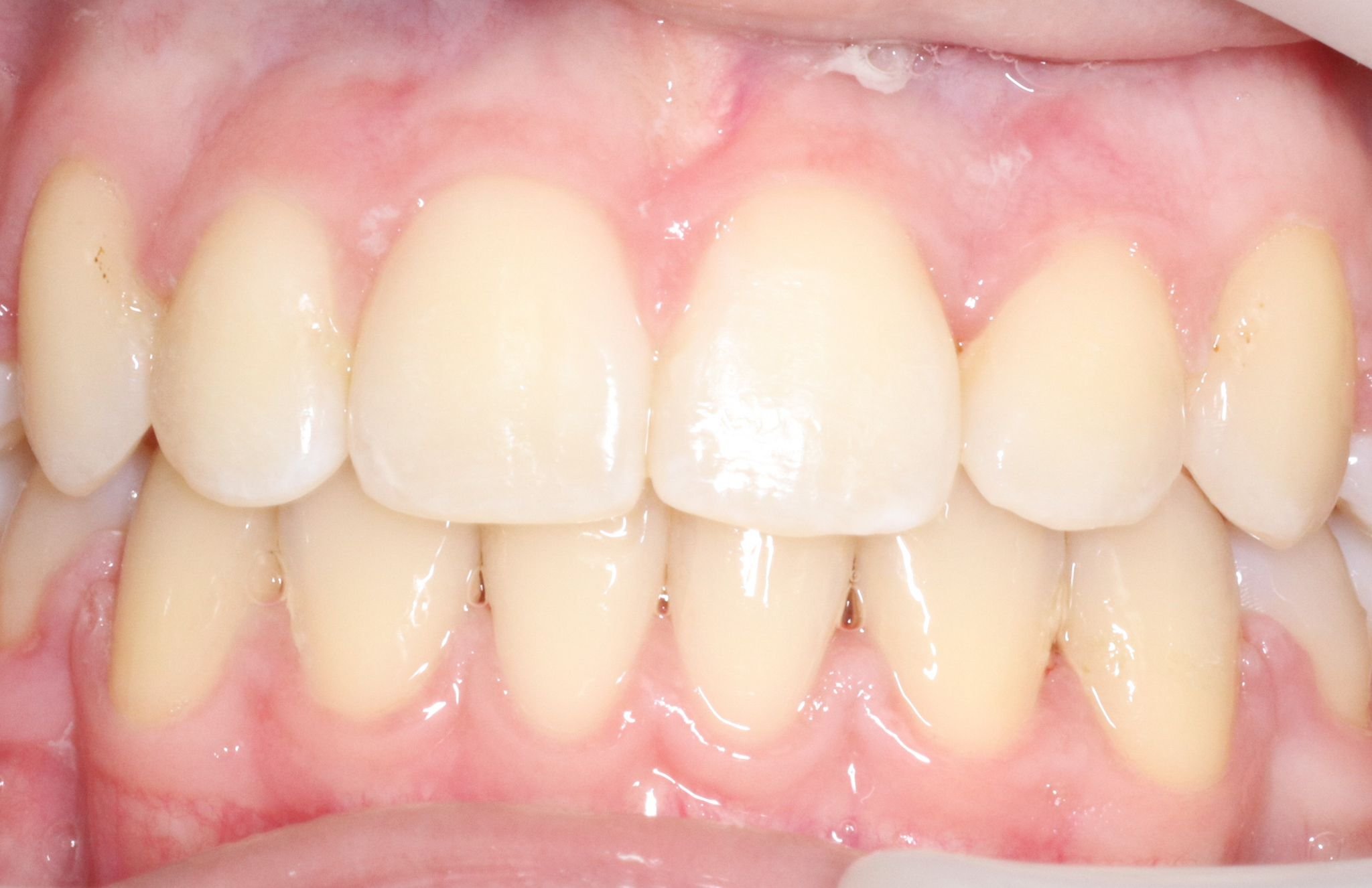 Close-up of upper and lower front teeth with healthy gums.