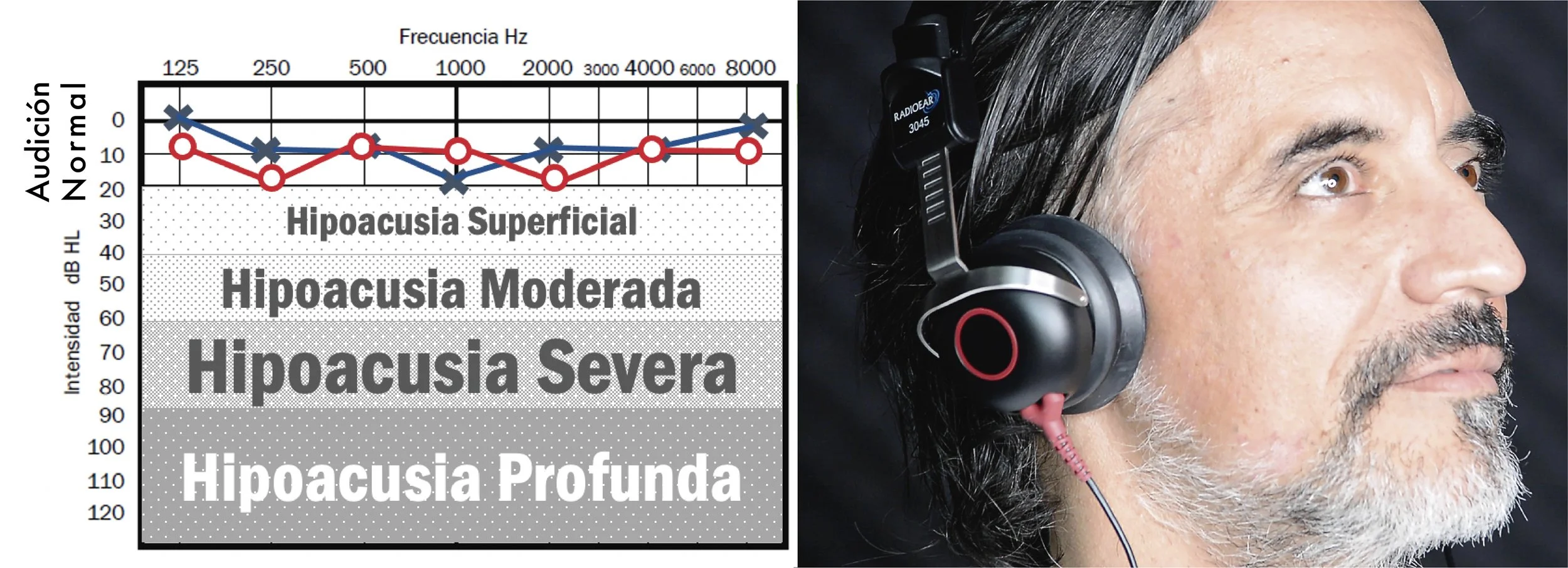 Un gráfico que muestra diferentes niveles de hipoacusia (pérdida de audición), desde superficial hasta profunda, con una línea que indica pérdida auditiva en diferentes frecuencias en Corti Centro Audiologico