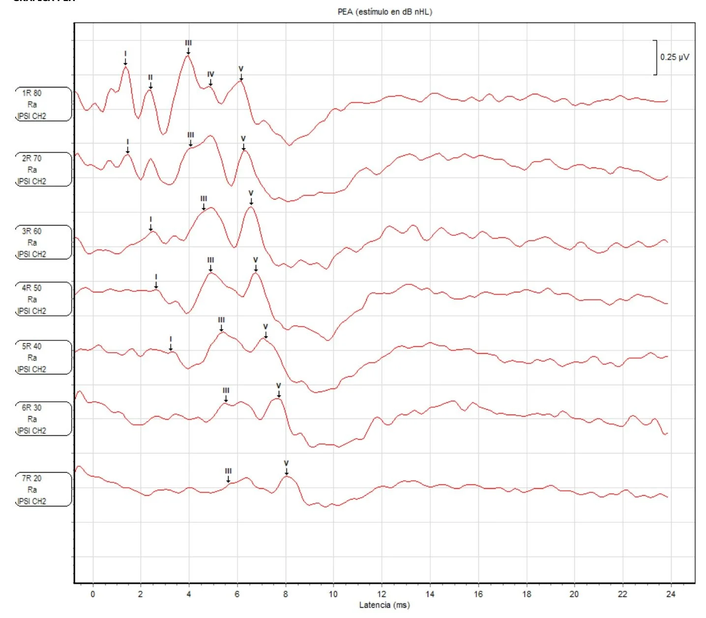 Gráfica de ondas que muestra respuestas EEG en diferentes canales, con marcas que indican picos y puntos específicos en las ondas, etiquetadas con números romanos y palabras como 'Ra', en relación al tiempo en milisegundos.