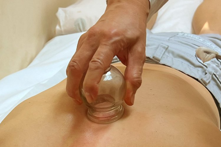 Close-up of Dr. Du's hand applying a clear glass cupping cup to a patient's back during a therapy session.