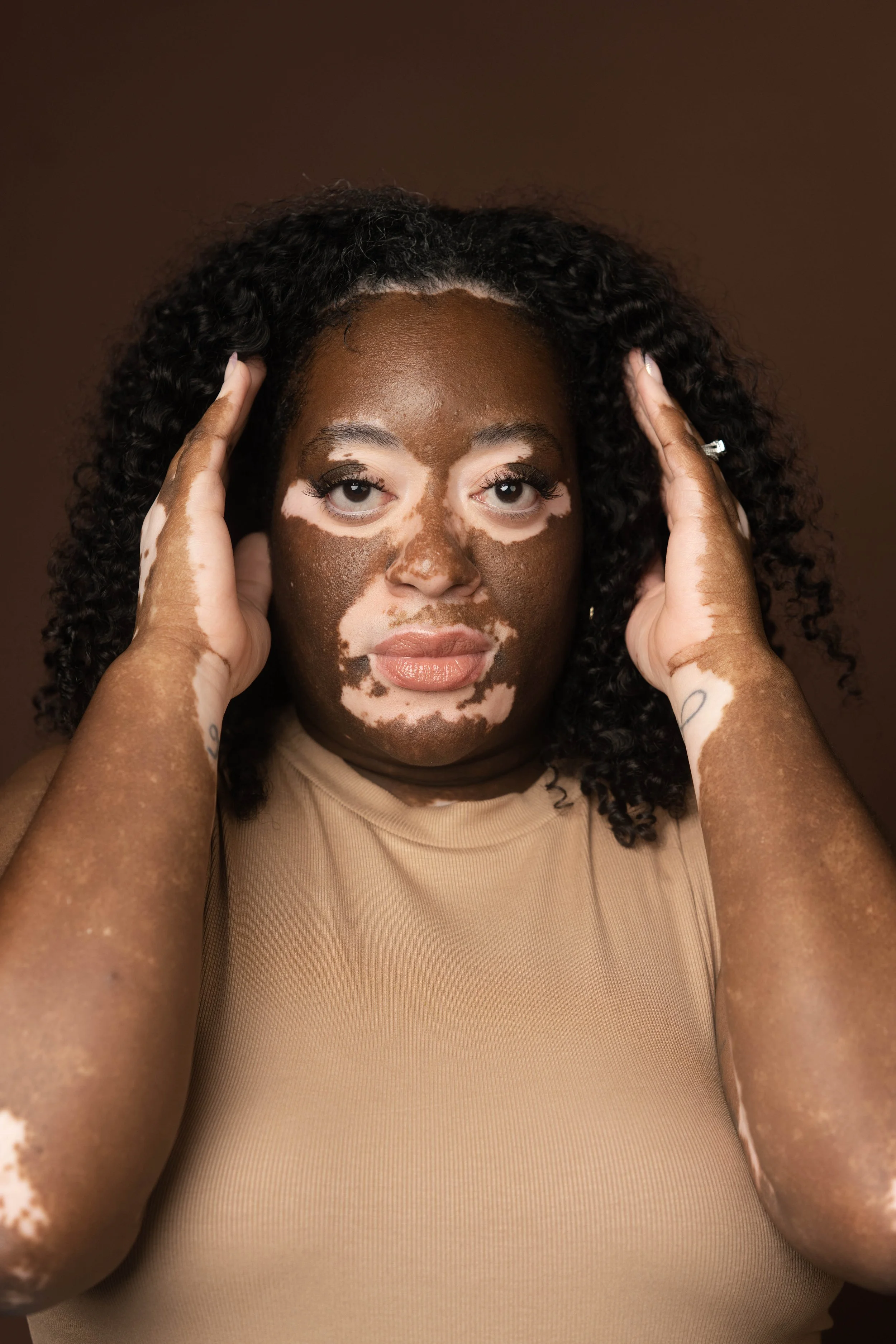 A woman with vitiligo posing with her hands on her head, wearing a beige top, against a plain brown background.