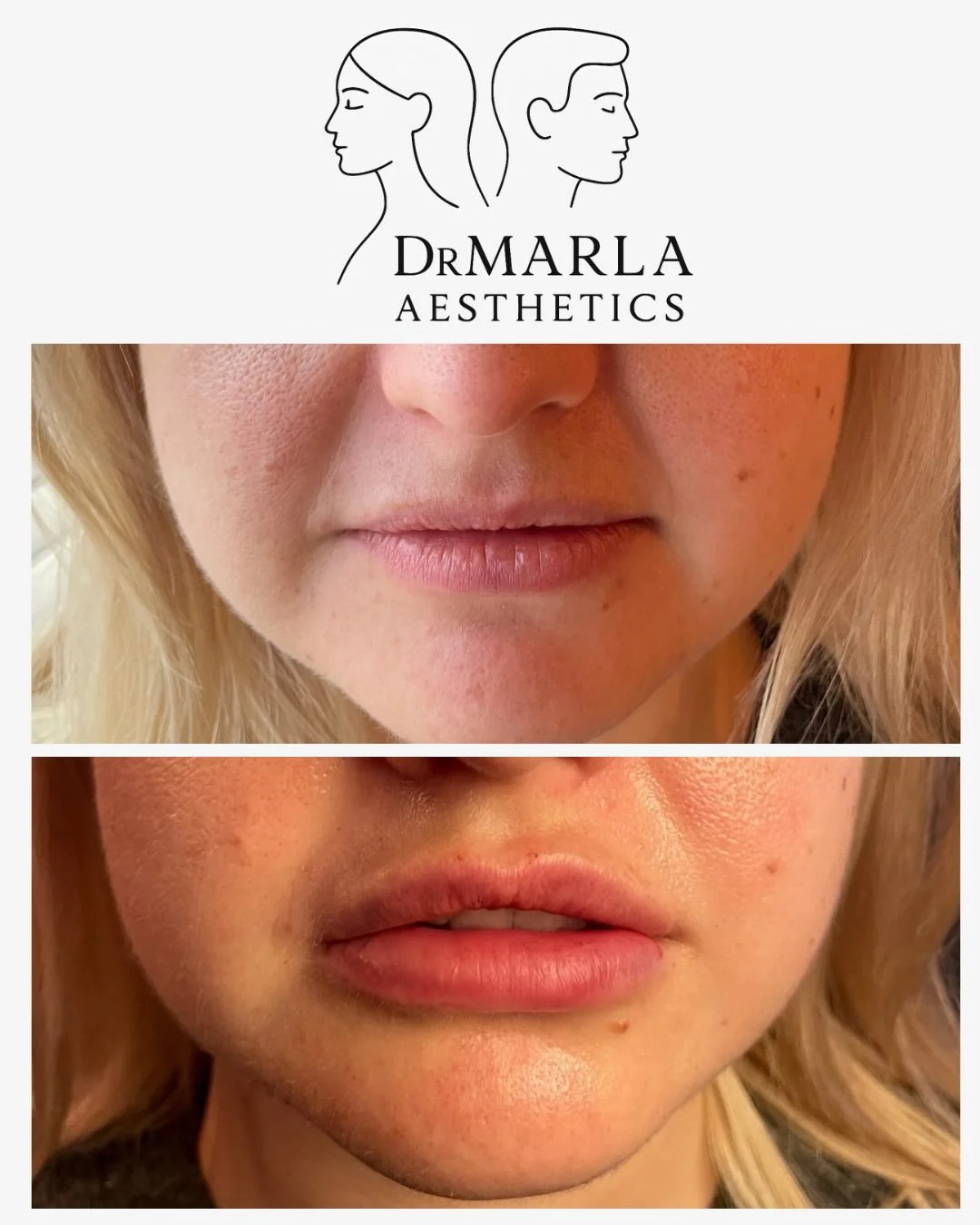Before &amp; after: subtle, natural lip enhancement
This 30-year-old client never had lip filler before wanted a refined upper lip without changing her overall look. She already had good lower-lip volume, so we focused on shaping and defining the upp