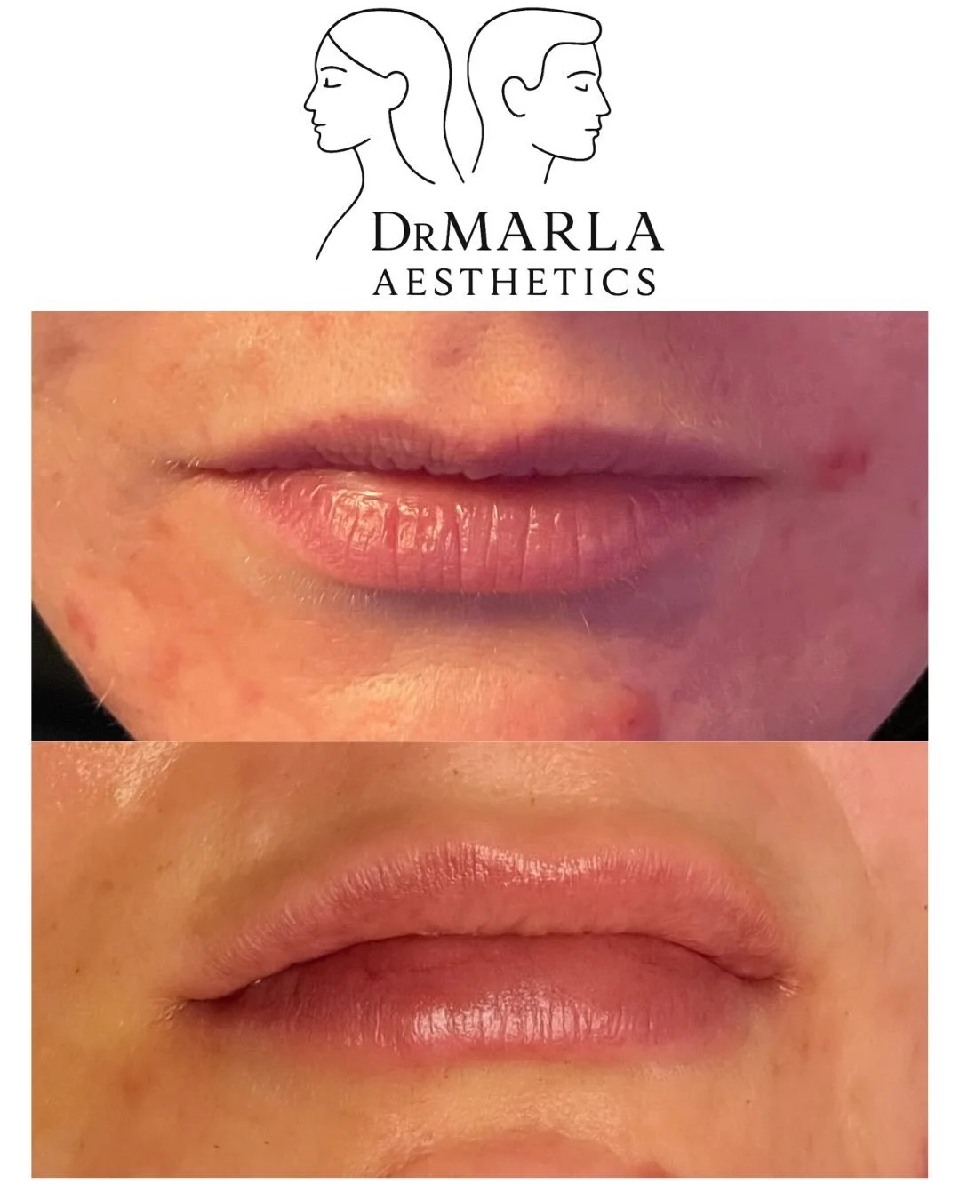 ✨ Subtle, Balanced Lip Enhancement ✨
27-year-old client came in with concerns about overall lip volume in both the upper and lower lip. During her full facial assessment, we looked at her lips in harmony with her nose, cheeks, and lips natural anatom
