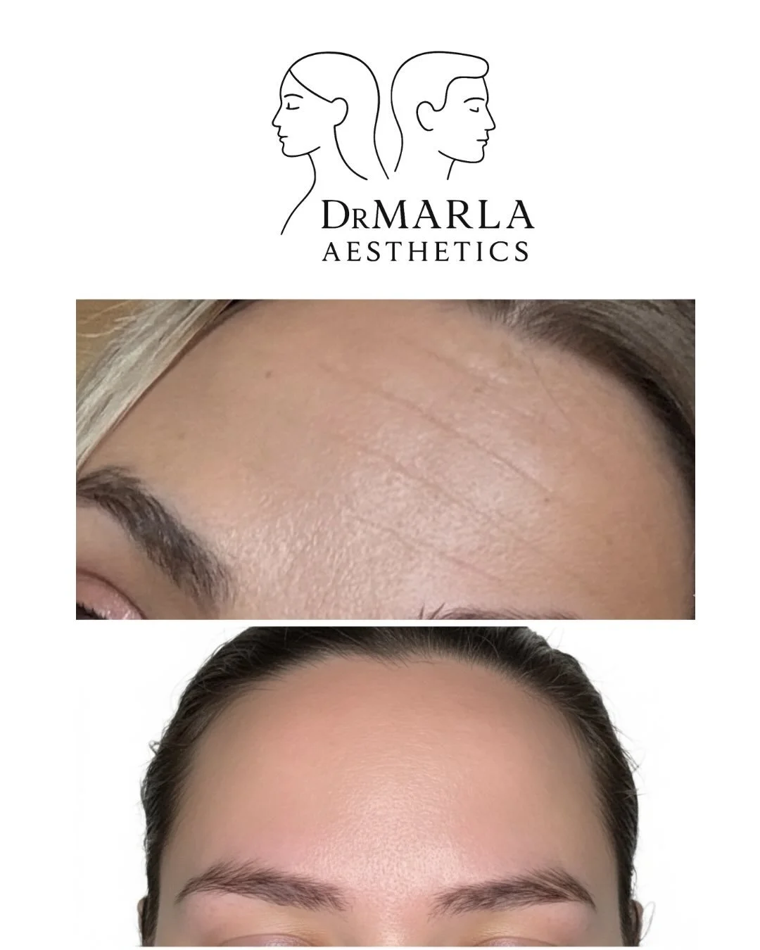 ✨ Before &amp; After: Upper Face Anti-Wrinkle Treatment ✨

Anti-wrinkle treatment is amazing at reducing those static lines, but with the right placement and dosage, dynamic lines are also softened while maintaining natural movement for a calm, less 