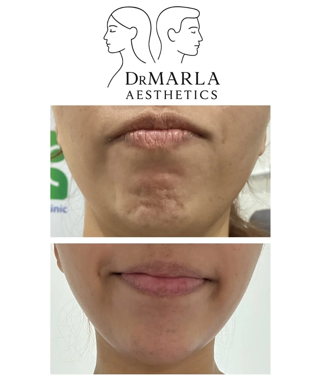 ✨ Before &amp; After Anti-Wrinkle Treatment ✨

Another happy patient in her 30s whose main concerns were dynamic forehead lines and chin dimpling.
Treatment areas included the forehead, frown lines, and mentalis muscle.

When it comes to anti-wrinkle