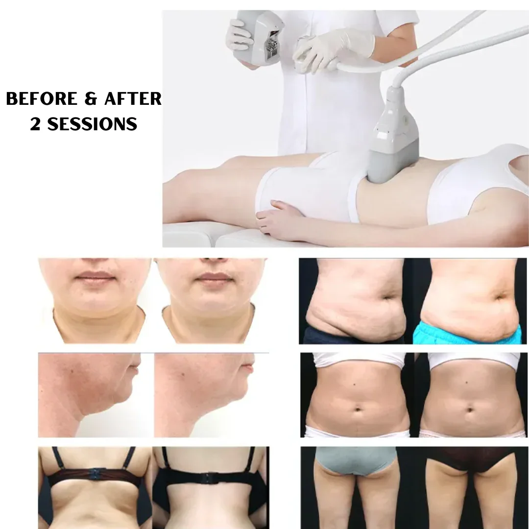 A collage showing before and after results of a body contouring treatment. The top right image shows a person lying on a bed receiving a non-invasive procedure on their abdomen. The other images depict before and after photos of face, waist, back, an