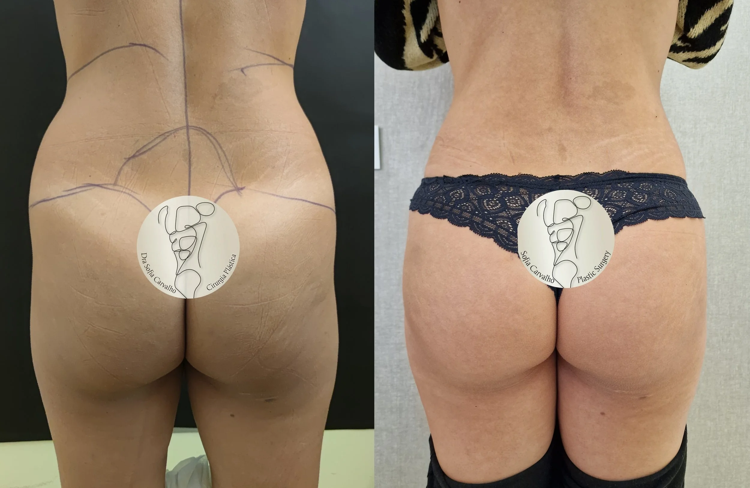 antes e depois aumento de glúteos