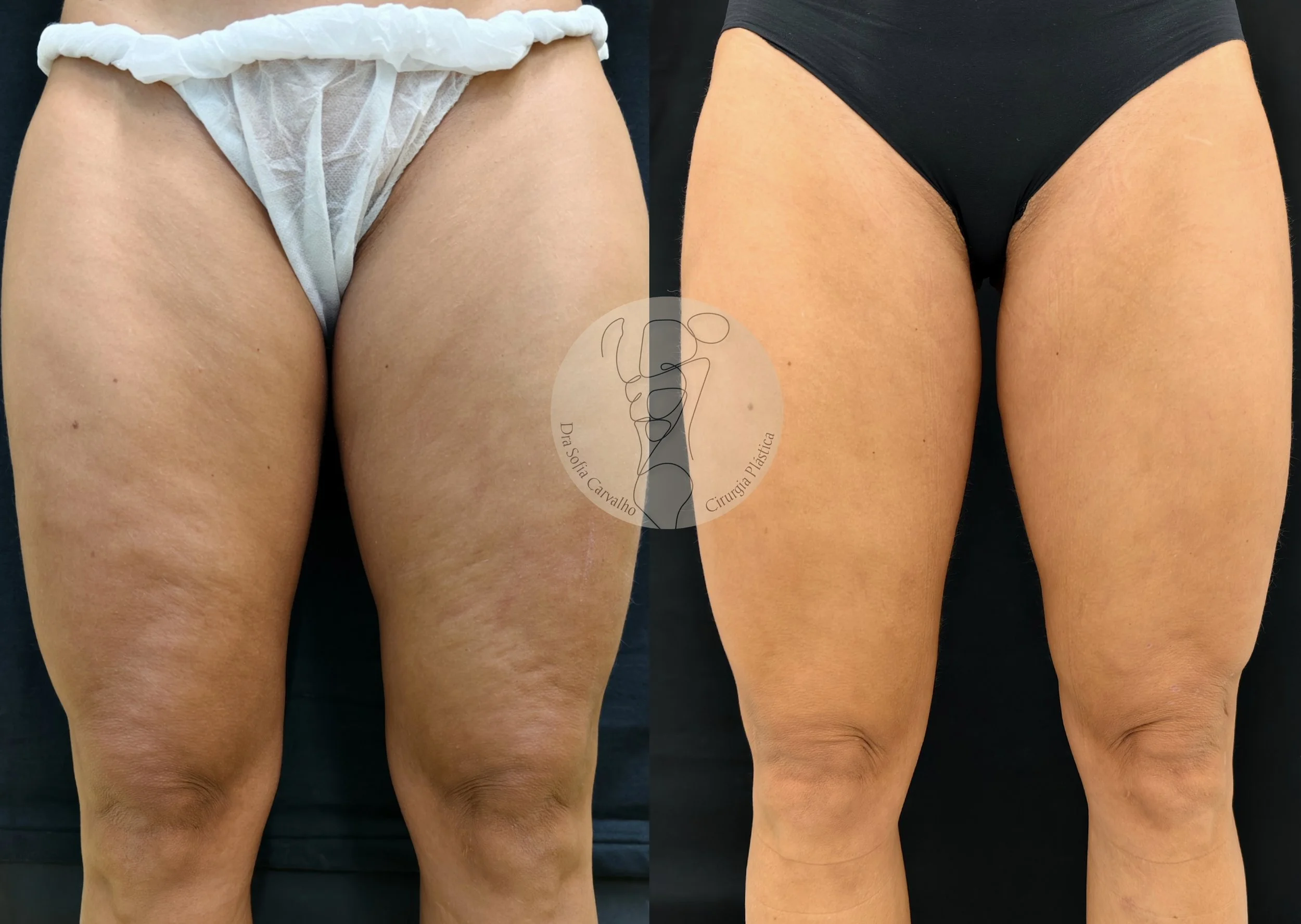 antes e depois renuvion e lipoHD