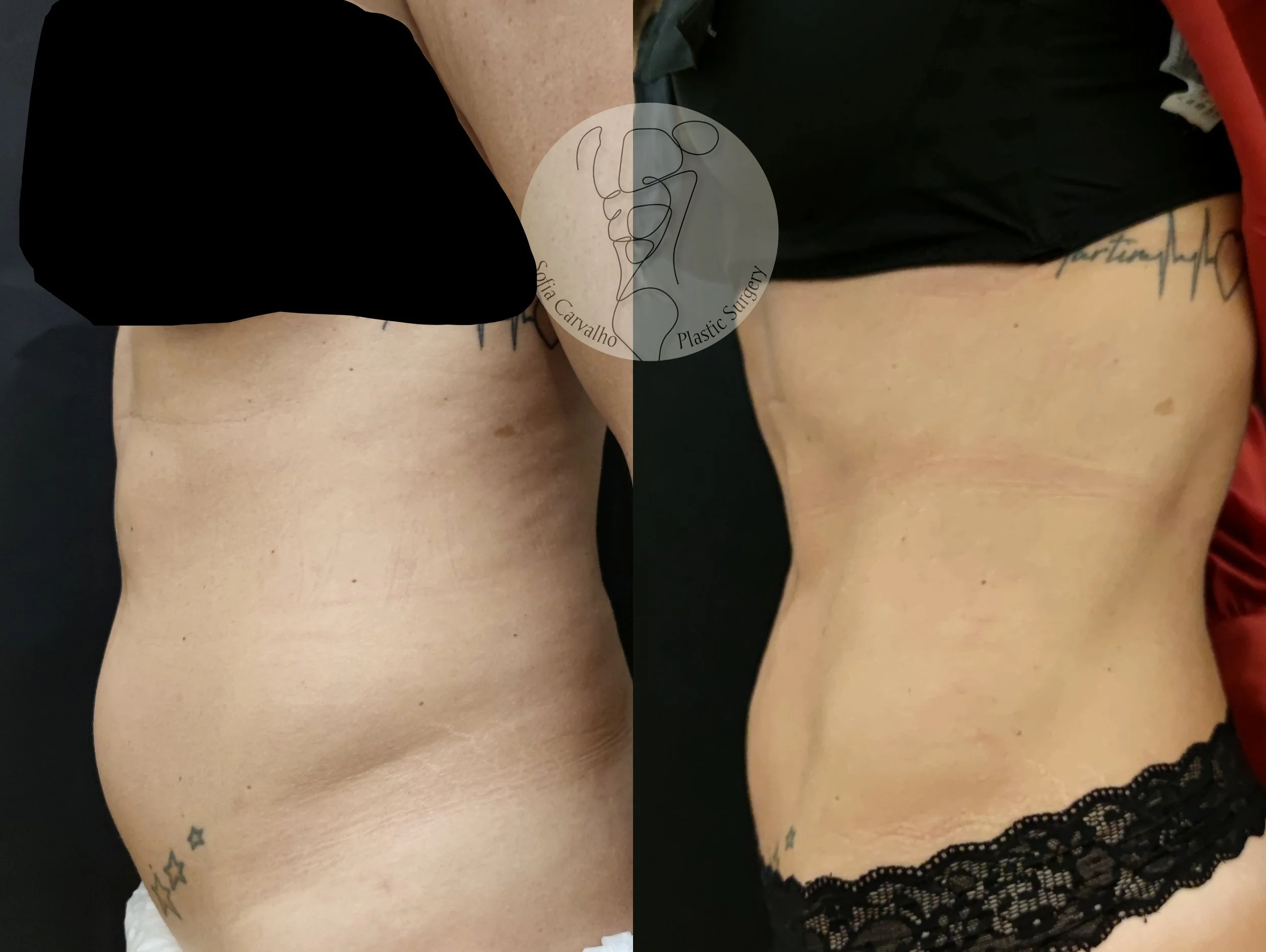 antes e depois com definição muscular em paciente com LIPO HD