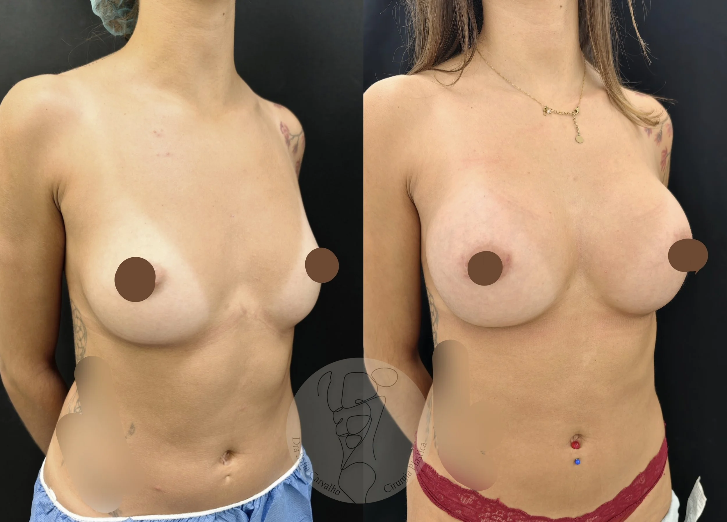 antes e depois de mamoplastia de aumento