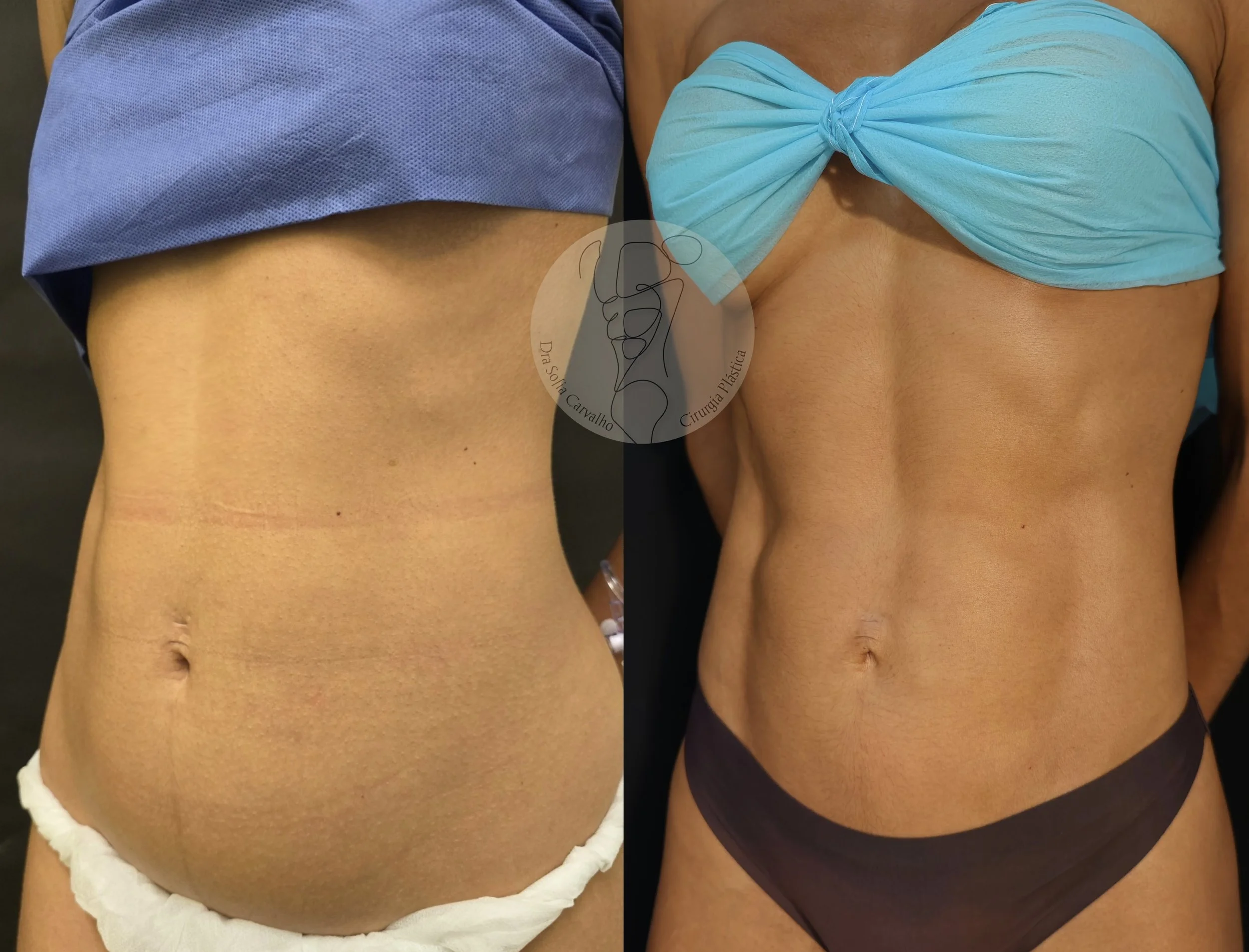 antes e depois de Lipo hd no abdómen