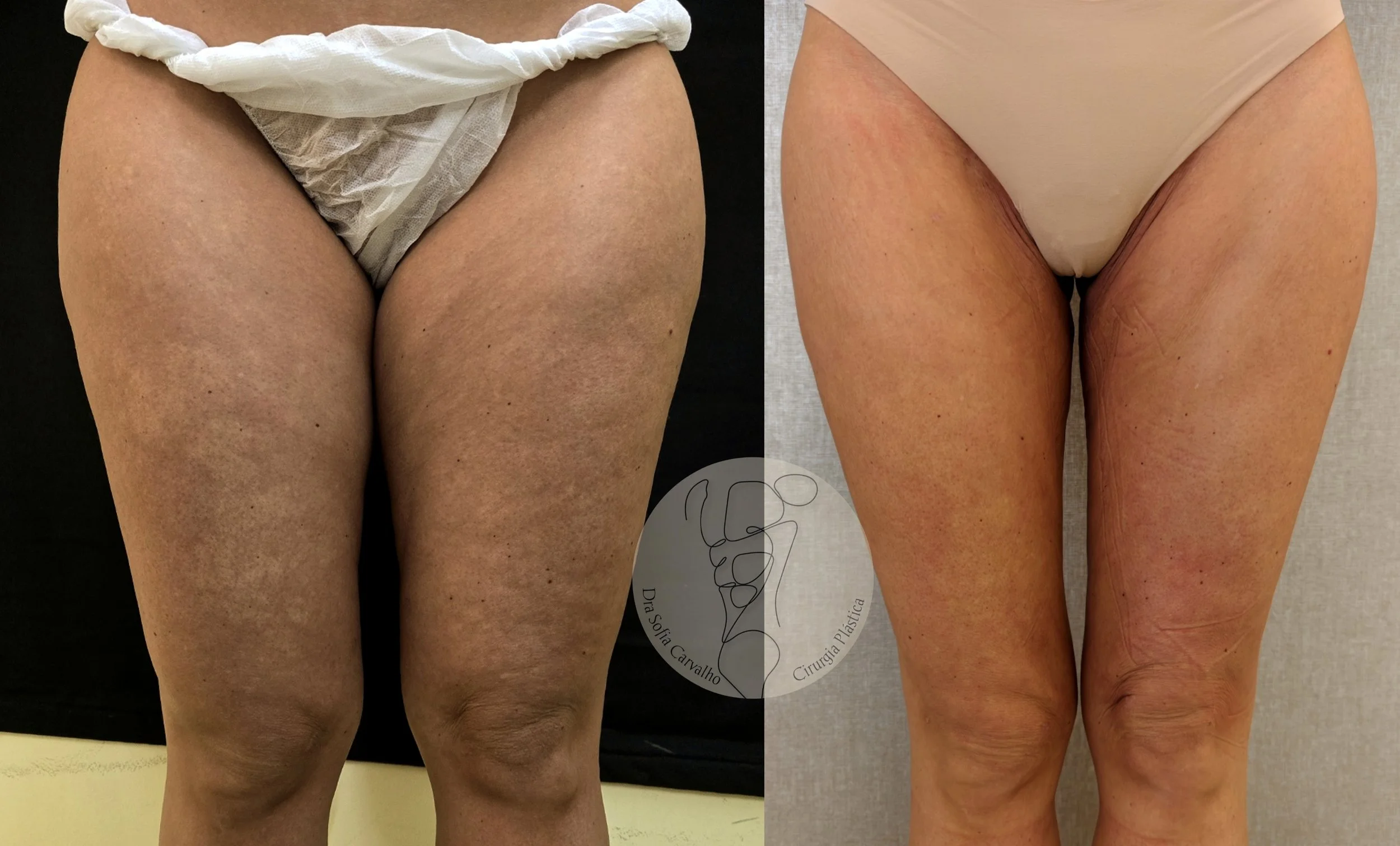 antes e depois lipedema