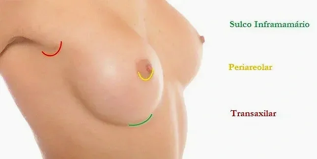 incisões na mamoplastia de aumento