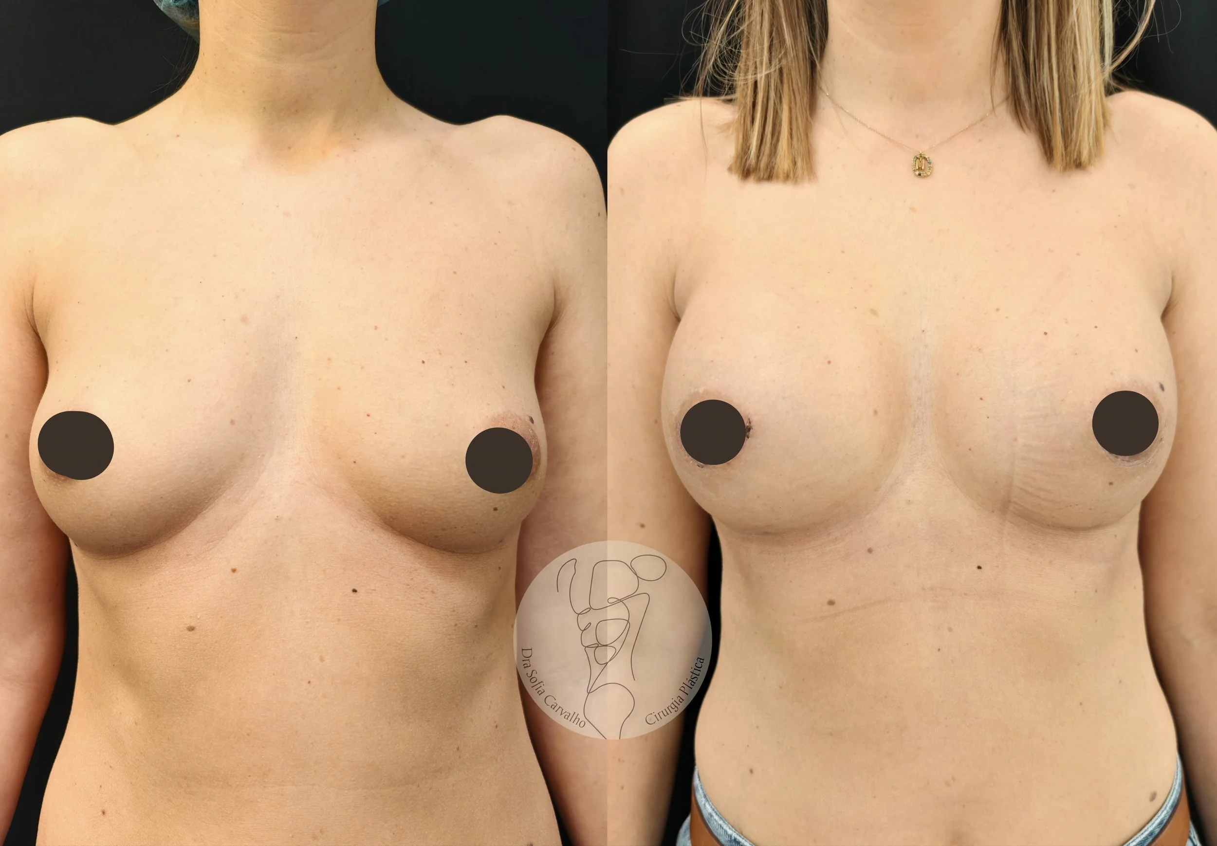 antes e depois mamoplastia de aumento