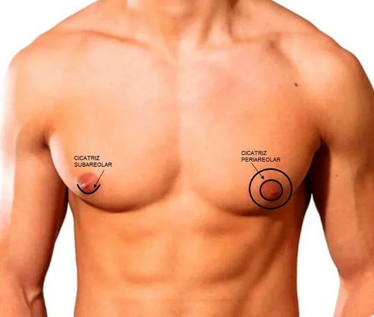 cicatriz de ginecomastia