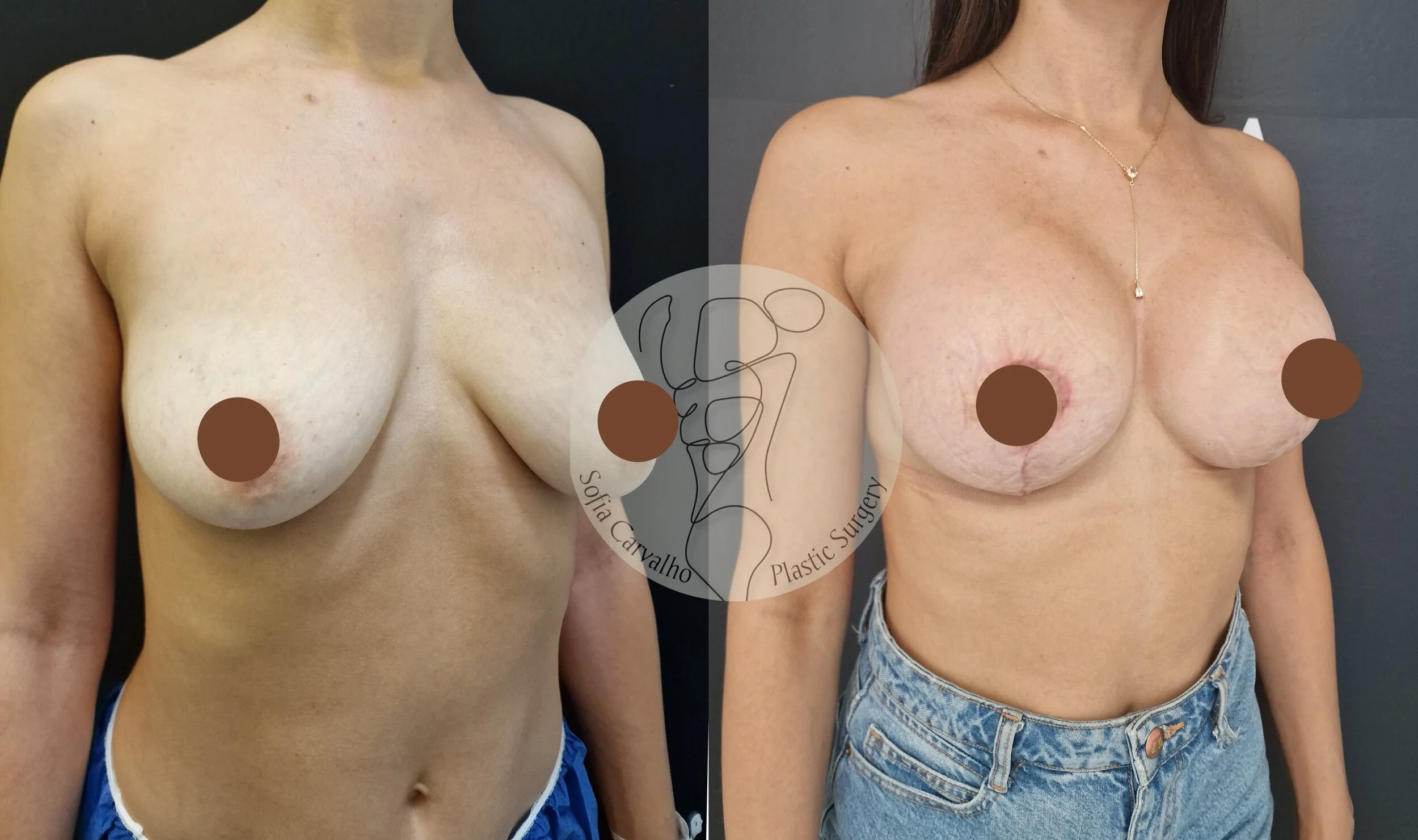 Mastopexia com próteses antes e depois