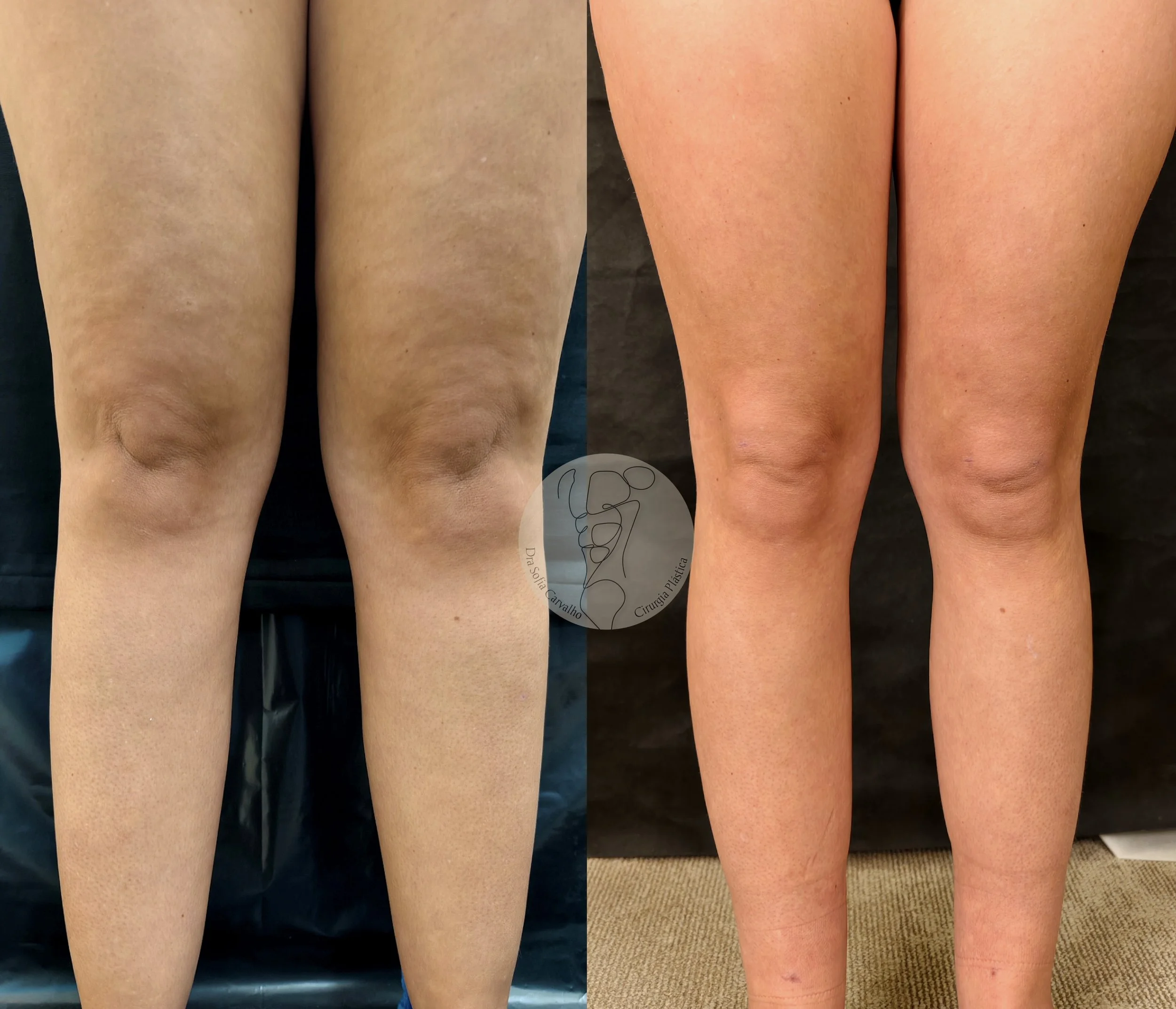 Imagem comparativa de duas pernas humanas antes e depois de um procedimento estético, com diferenças visíveis na textura e tonalidade da pele, sendo a do lado esquerdo mais escura e com irregularidades, e a do lado direito mais clara e uniforme.