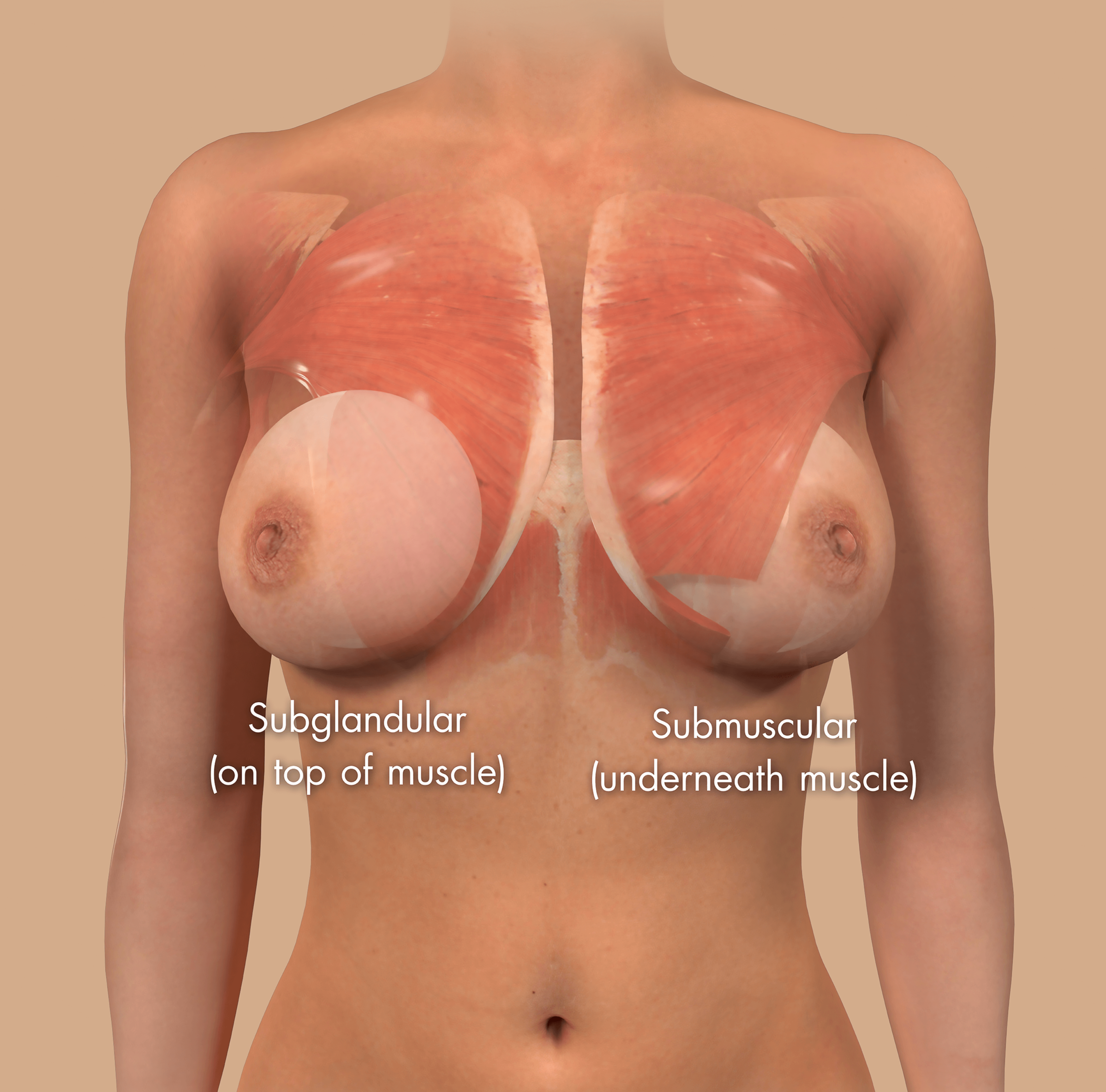 plano de colocação do implante: subglandular ou submuscular