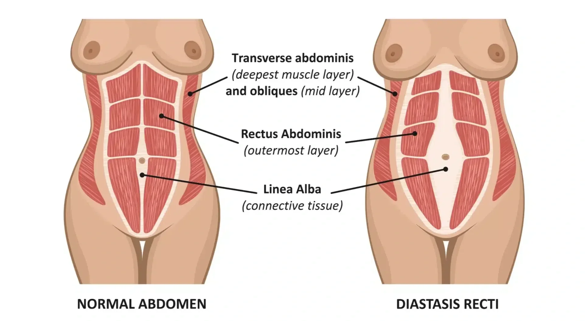 diástase abdominal