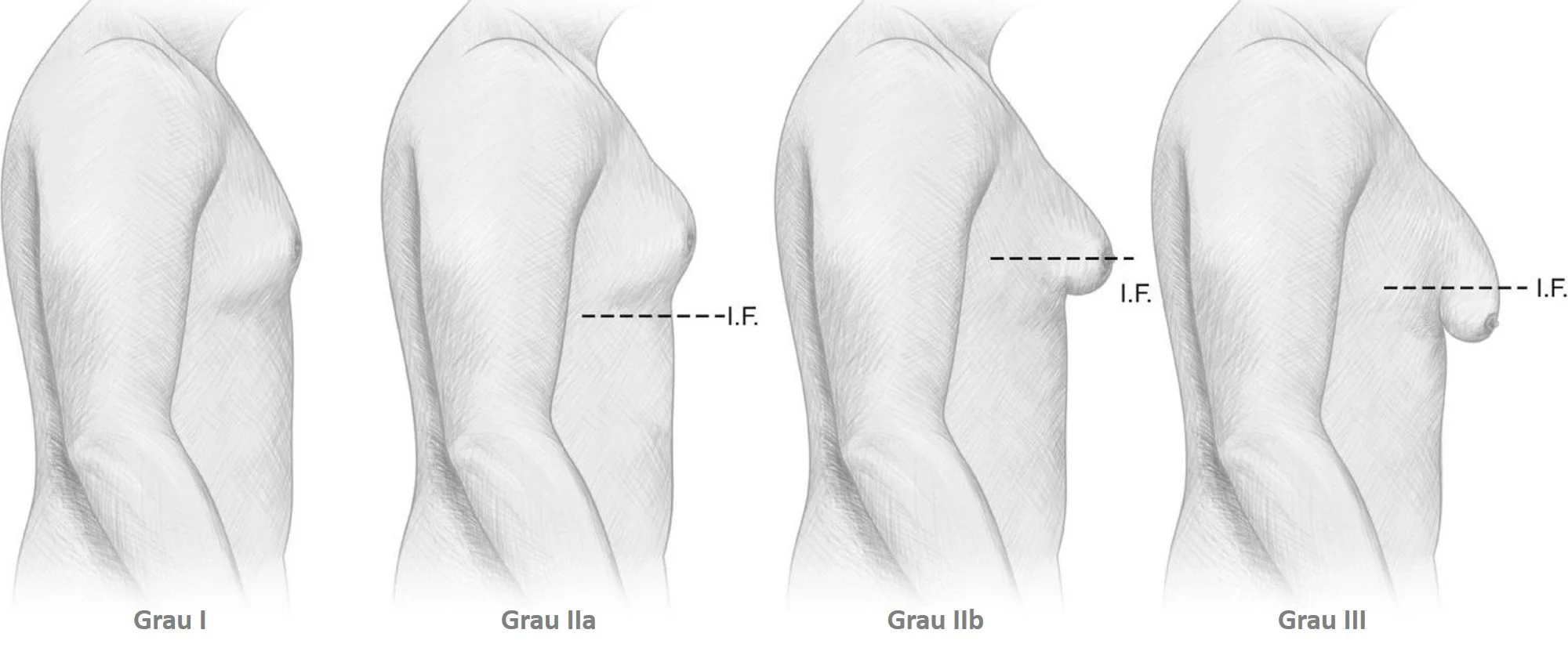 classificação ou graus de ginecomastia