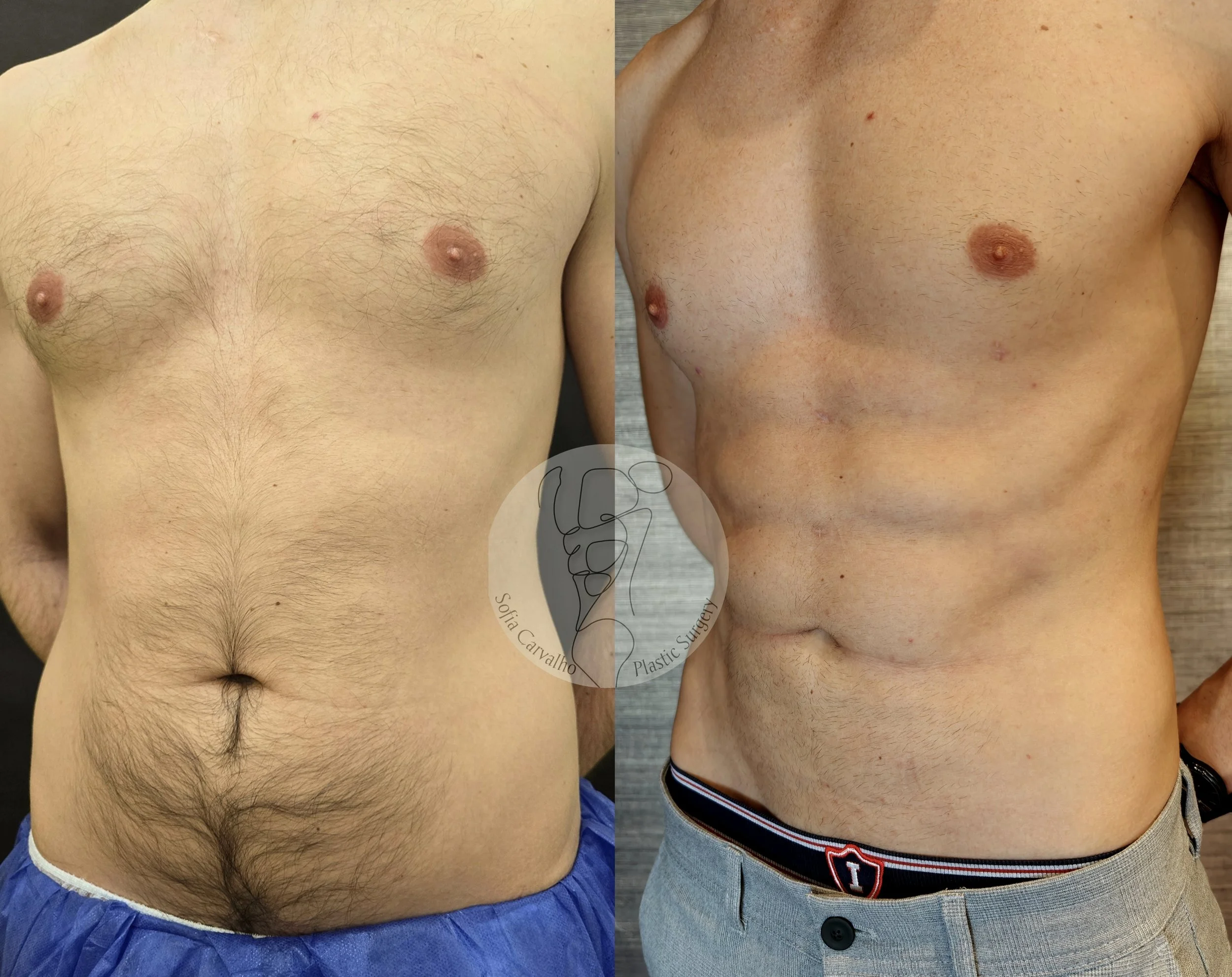 antes e depois Lipo HD no abdómen