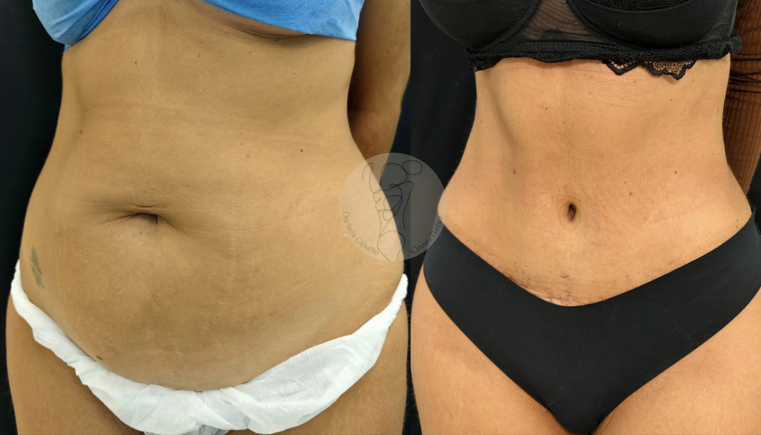 antes e depois de abdominoplastia