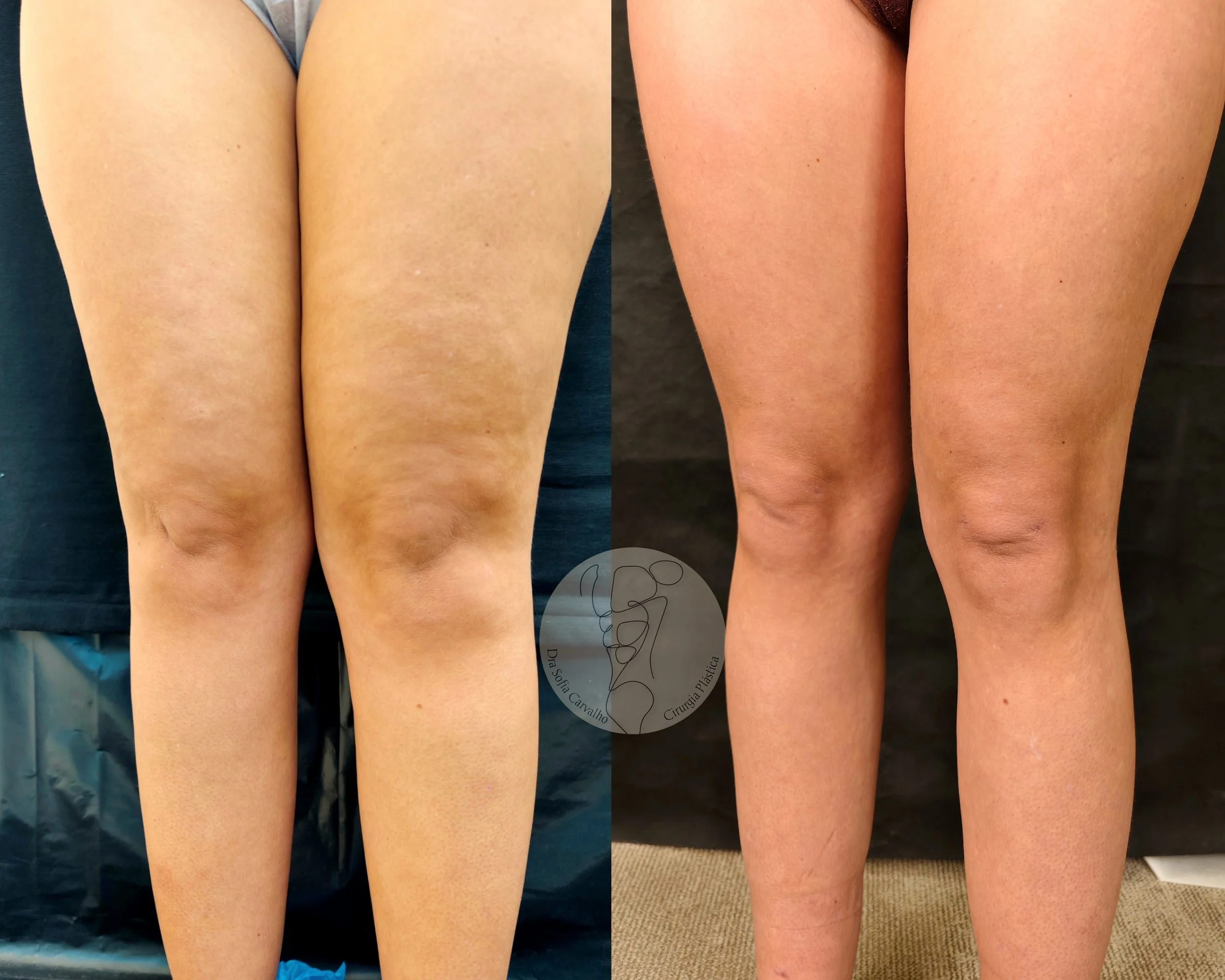 Imagem comparativa de antes e depois de uma cirurgia nas pernas, mostrando redução de gordura e melhor definição.