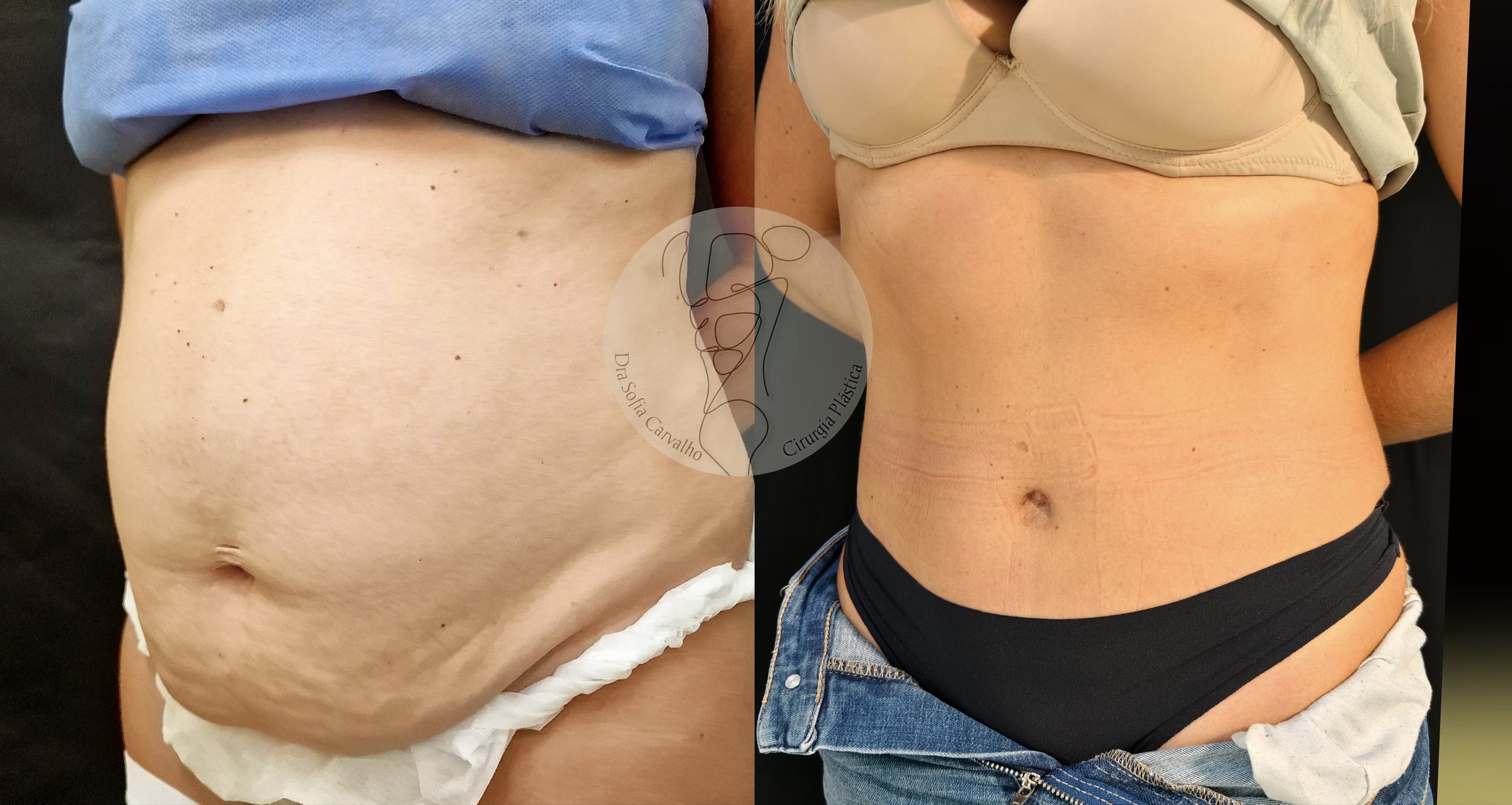 antes e depois de abdminoplastia