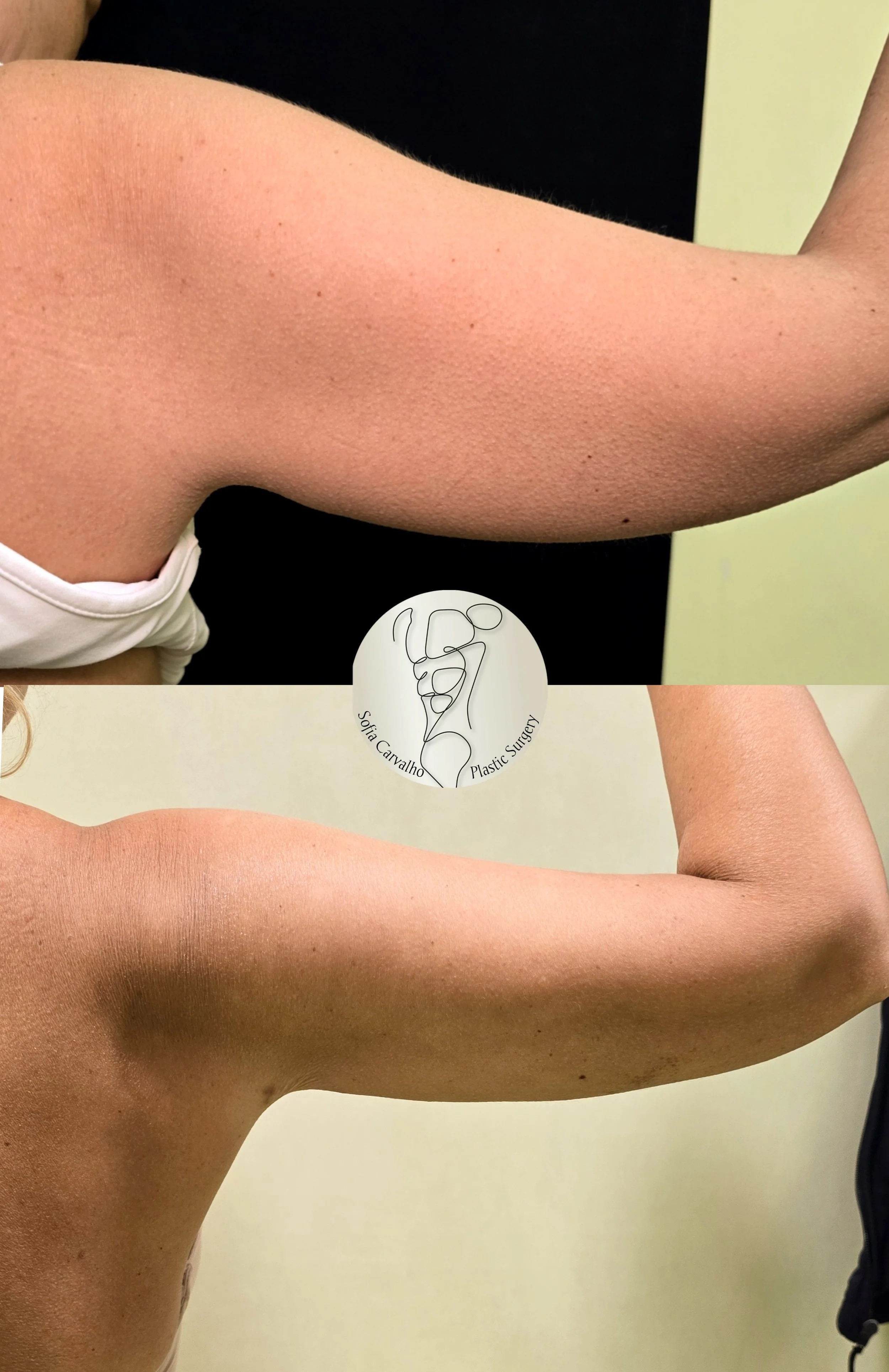 lipo HD braços antes e depois