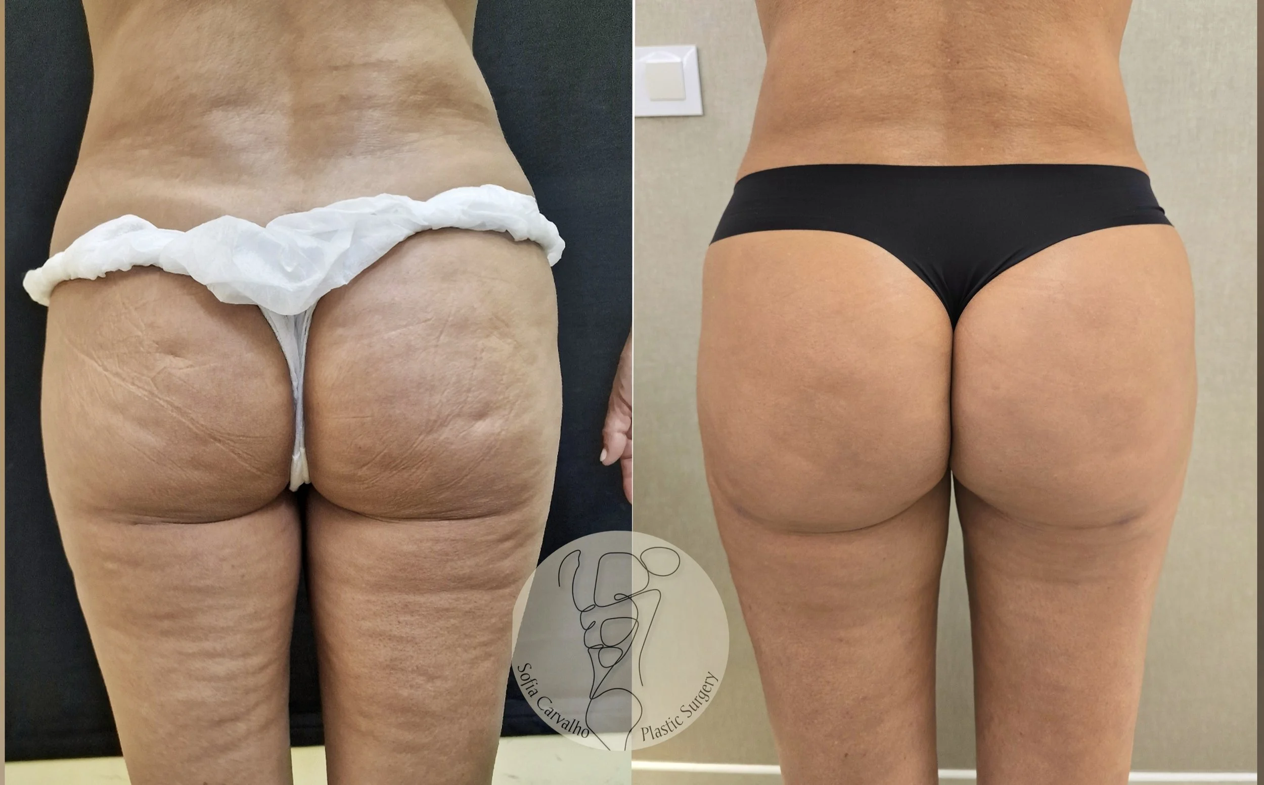 Macro e microfat para aumento de volume e tratamento da celulite