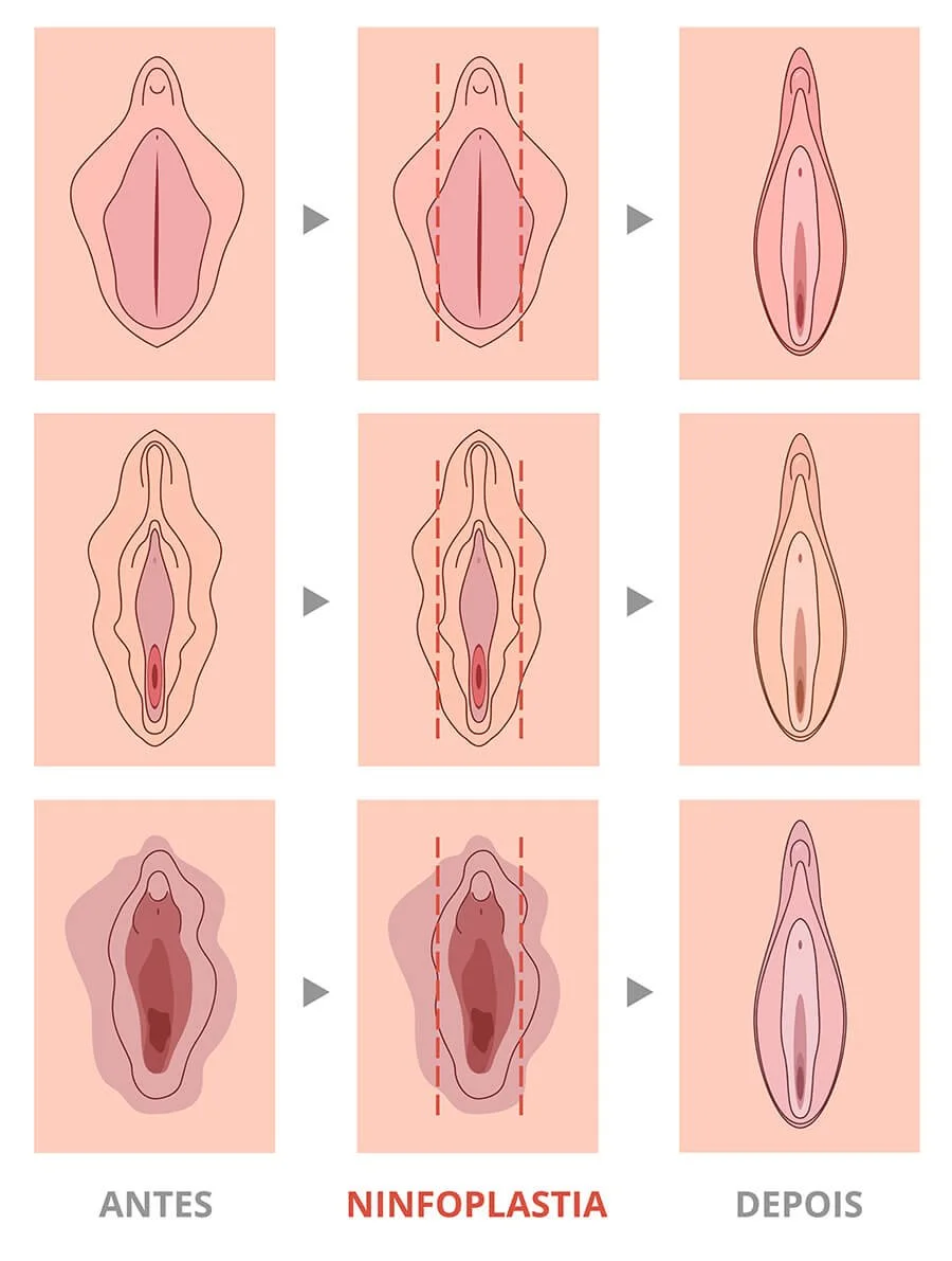 ninfoplastia