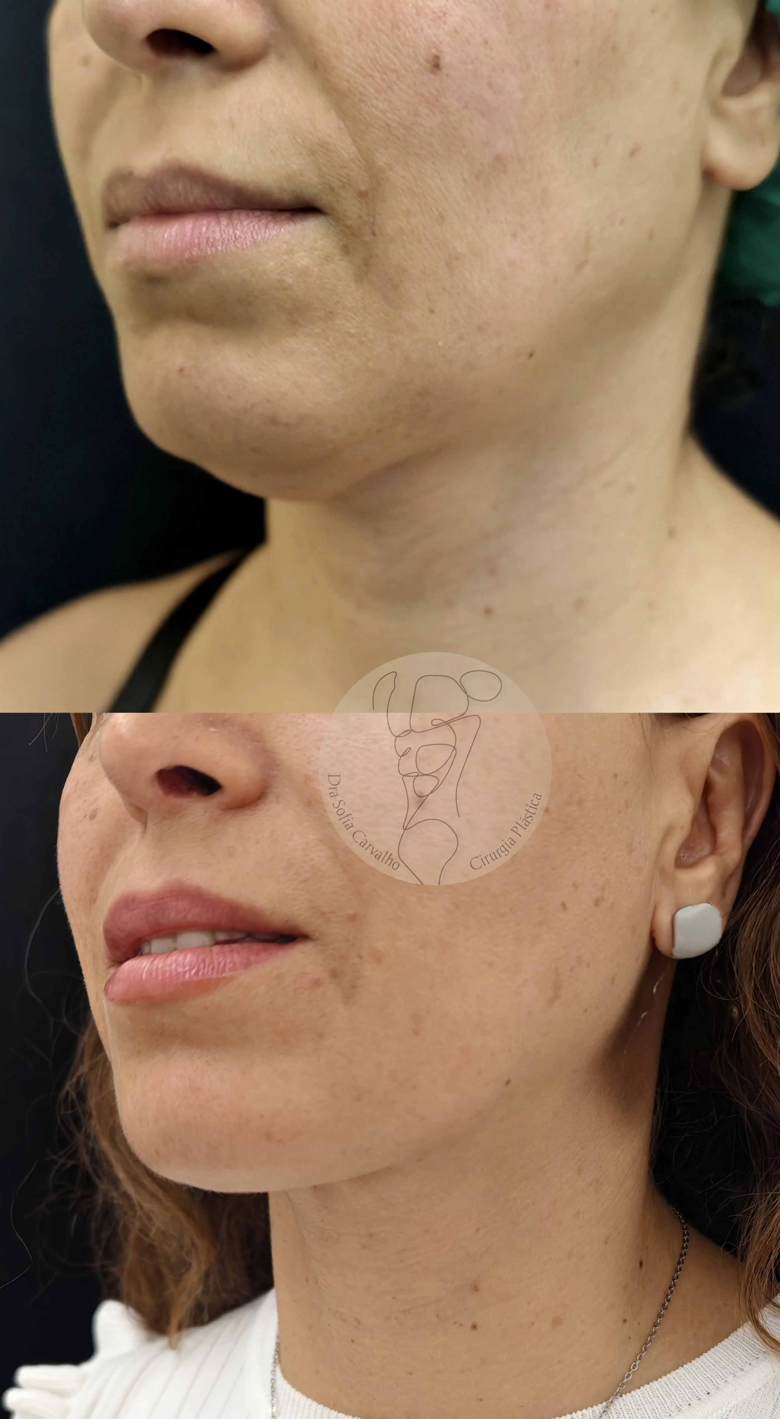 renuvion face e pescoço