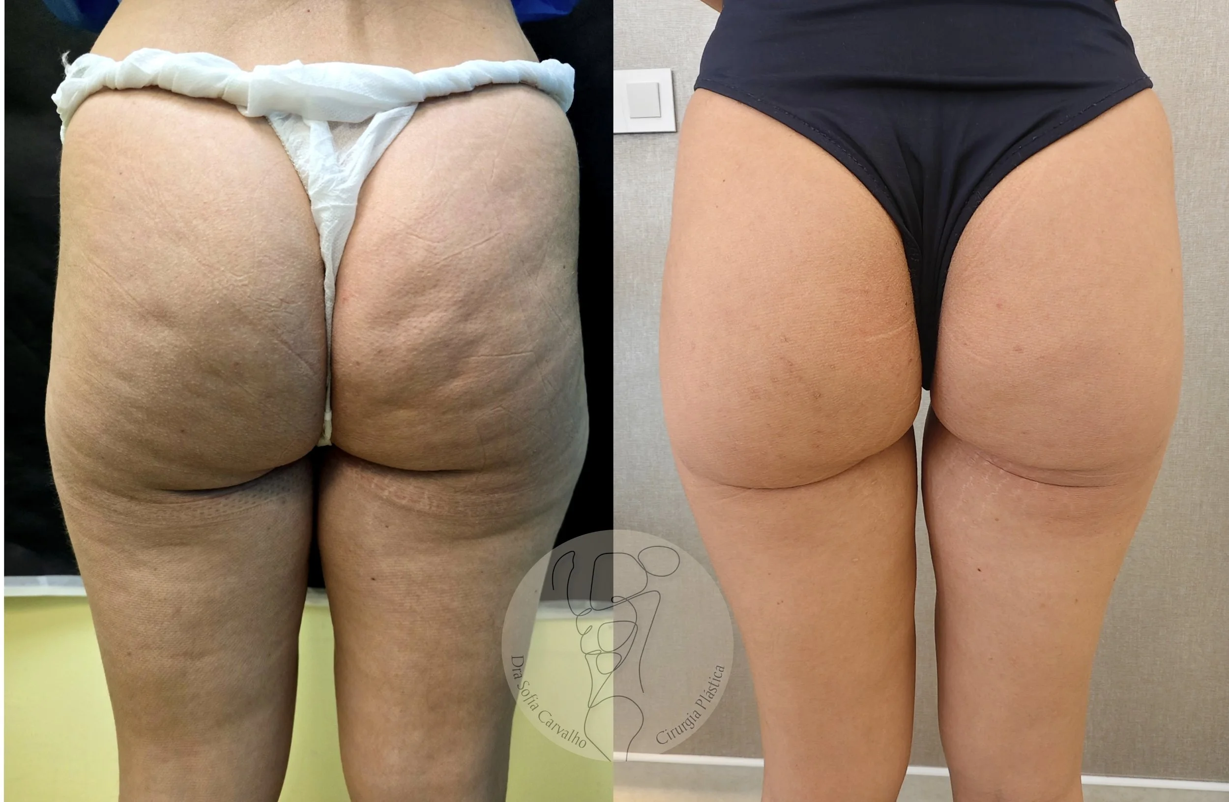 antes e depois de celulite