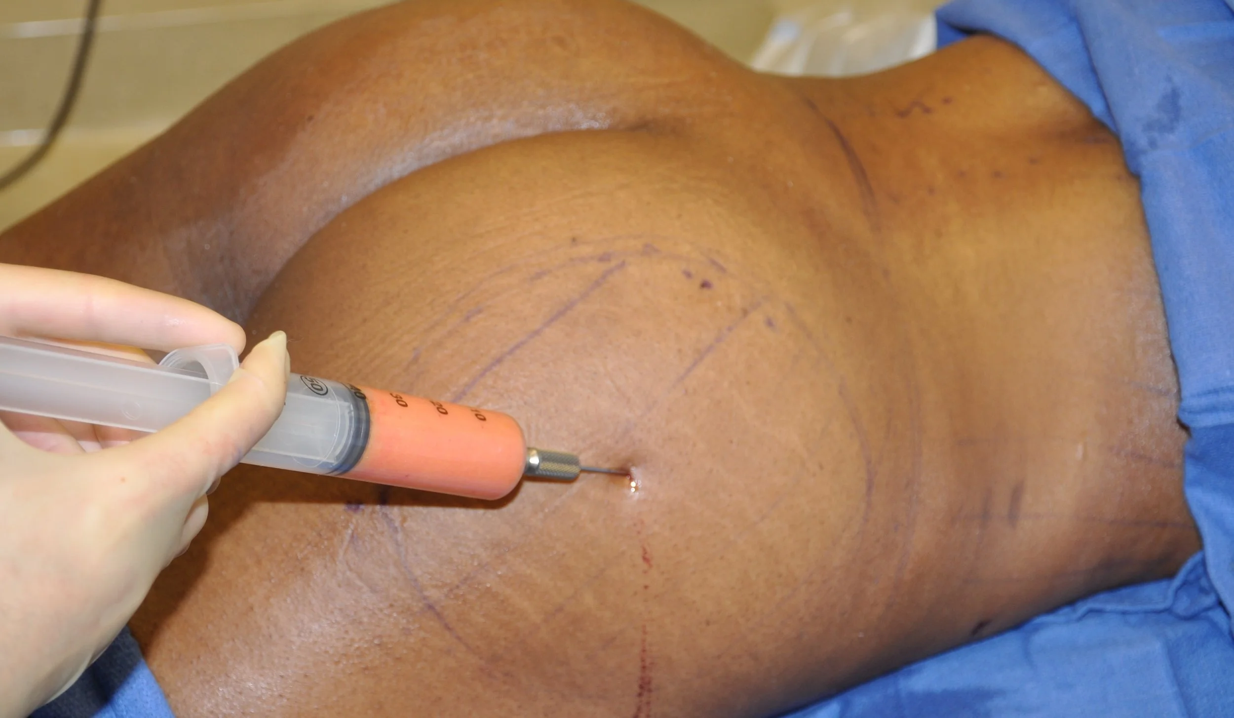 lipofilling e aumento de glúteos