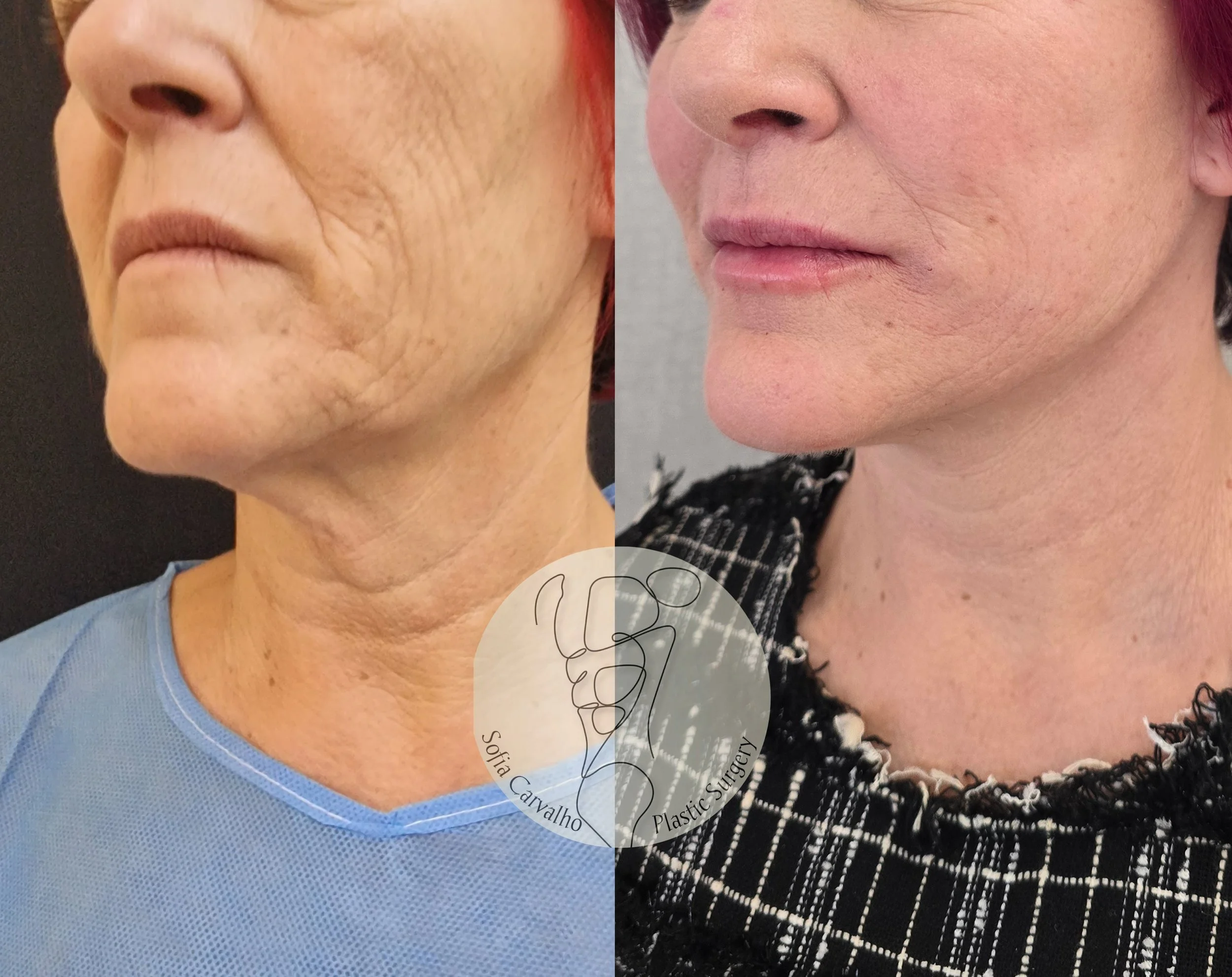 facelift antes e depois